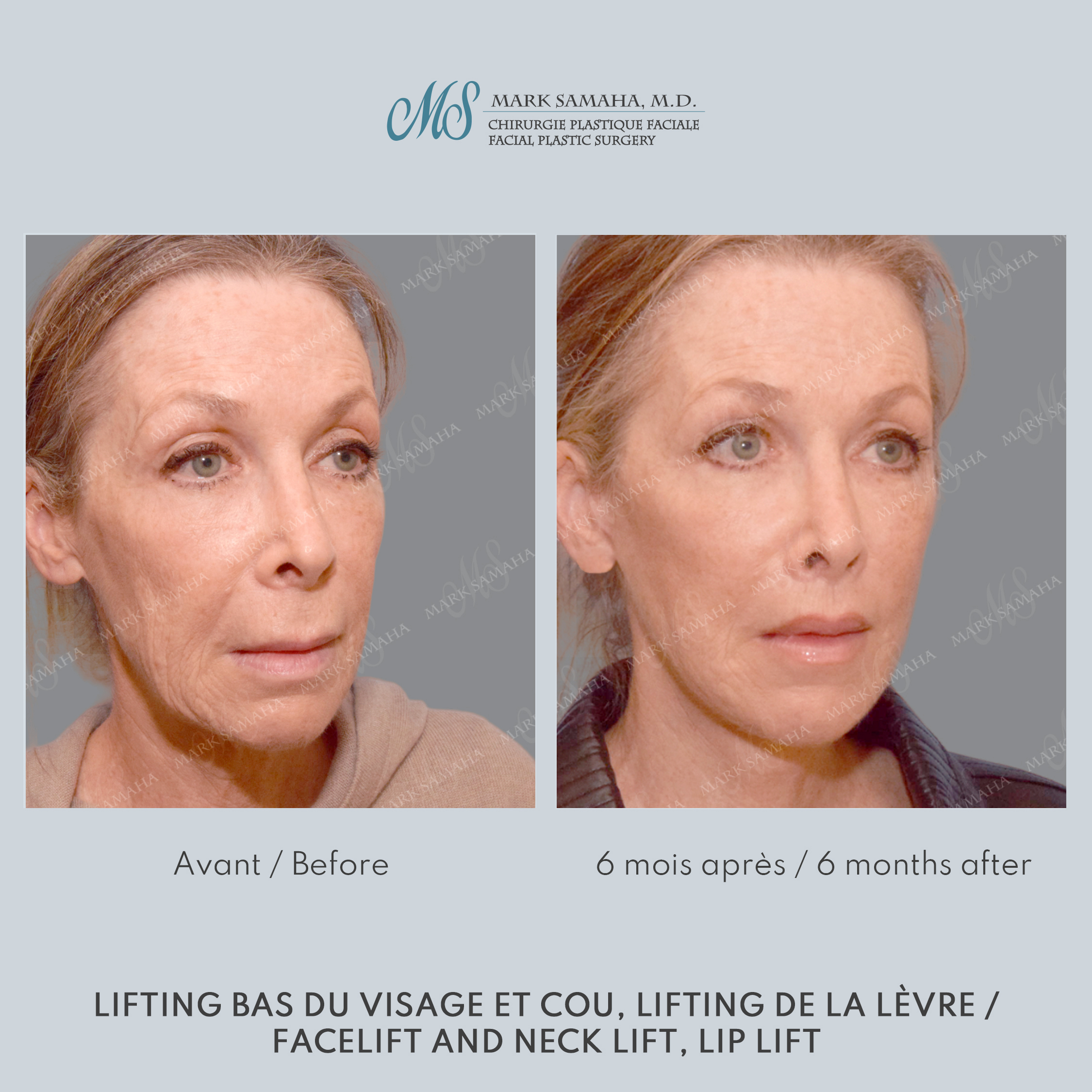 Before & After Lifting du visage / Cou - Facelift / Necklift Case 237 View #1 Detail View in Montreal, QC