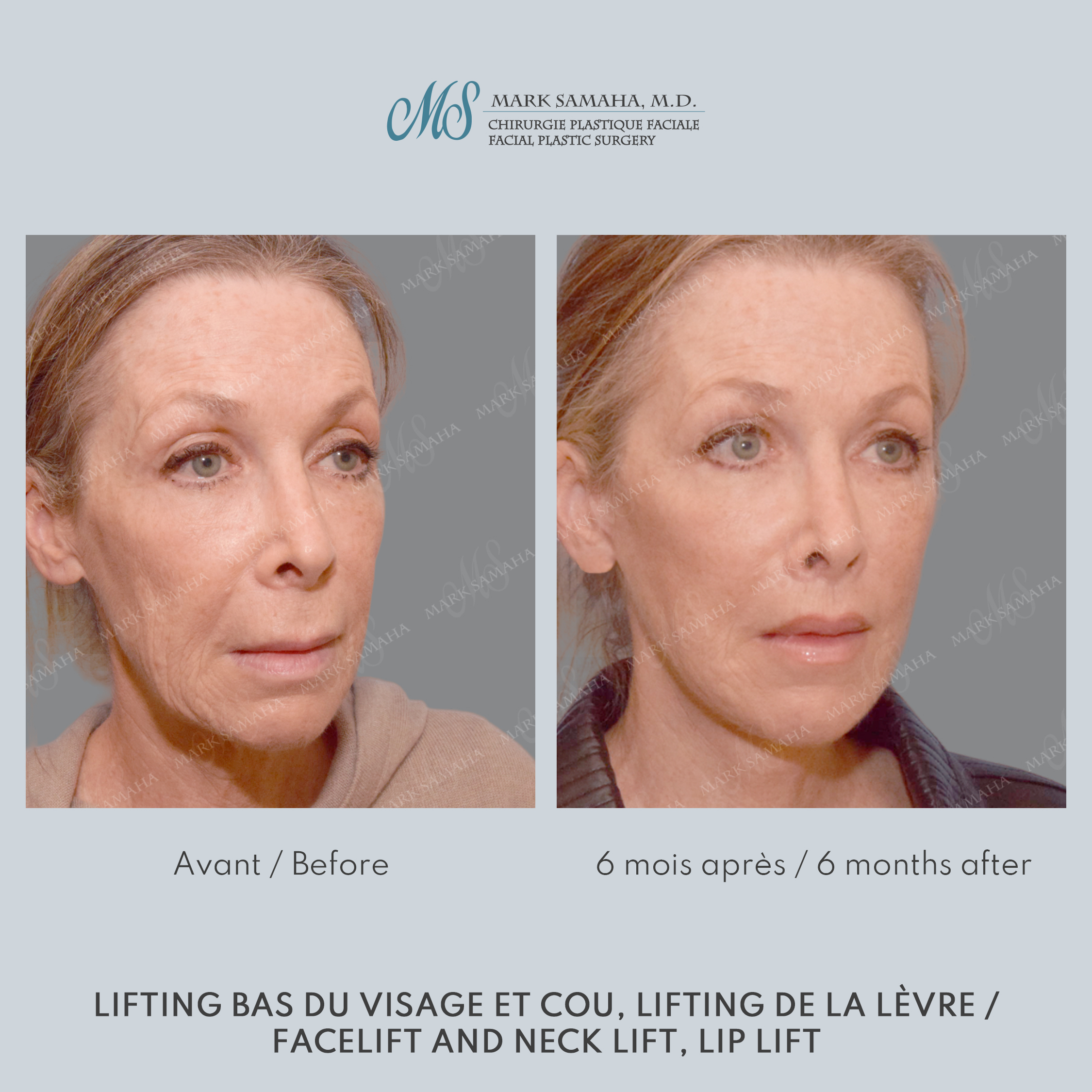 Before & After Lifting du visage / Cou - Facelift / Necklift Case 237 View #1 View in Montreal, QC