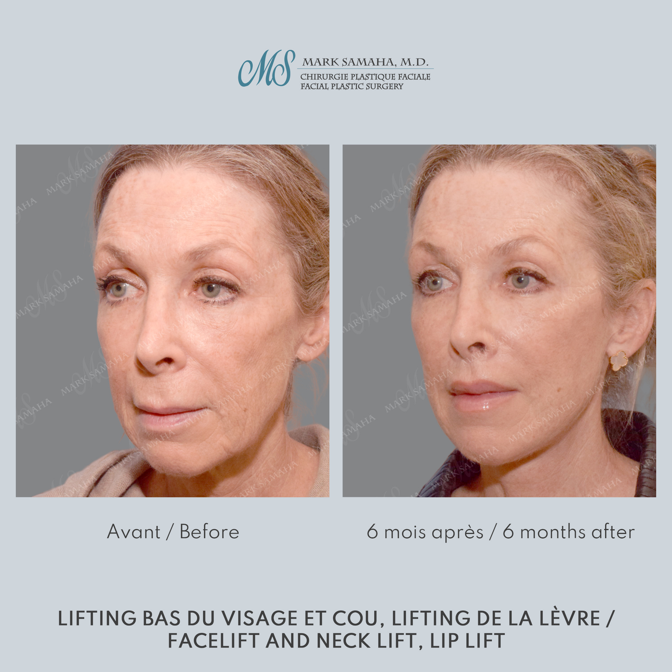 Before & After Lifting du visage / Cou - Facelift / Necklift Case 237 View #2 Detail View in Montreal, QC