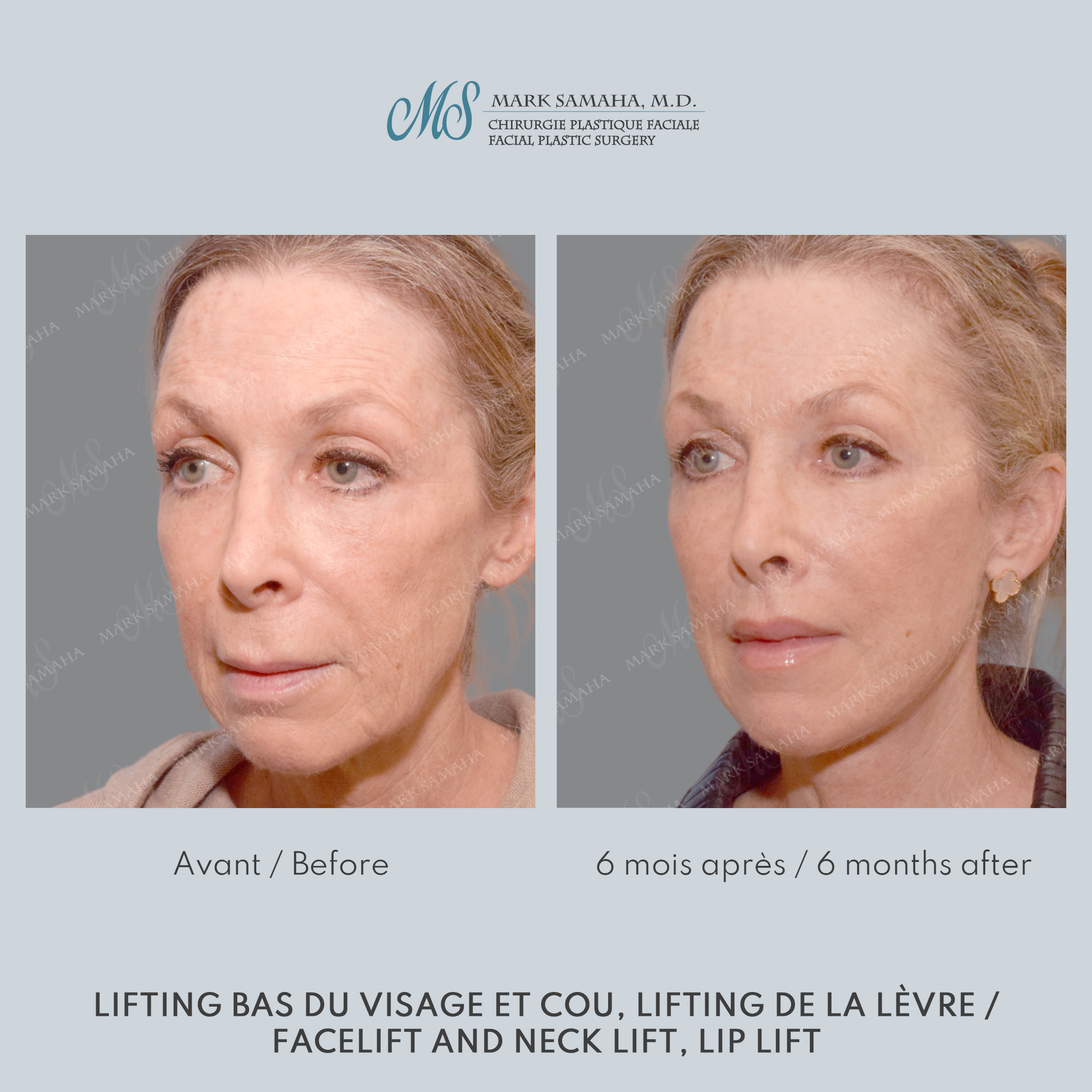 Before & After Lifting du visage / Cou - Facelift / Necklift Case 237 View #2 View in Montreal, QC