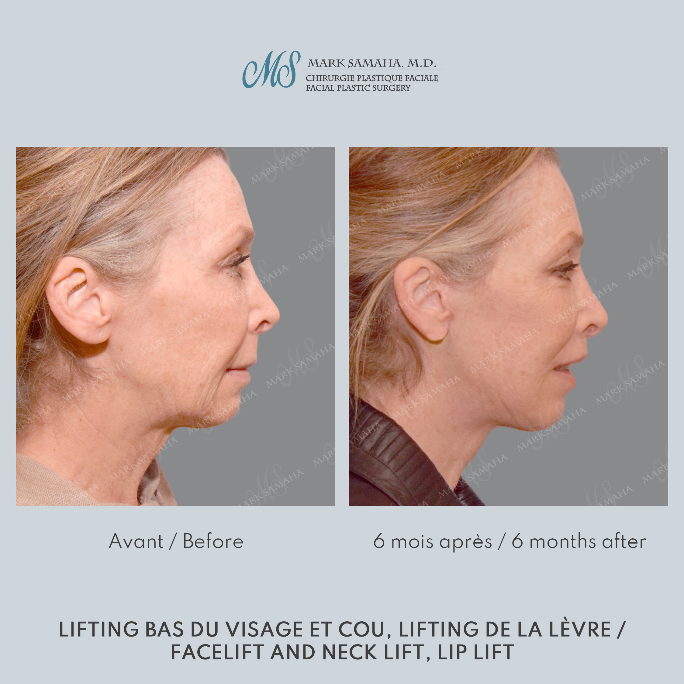 Before & After Lifting du visage / Cou - Facelift / Necklift Case 237 View #3 Detail View in Montreal, QC