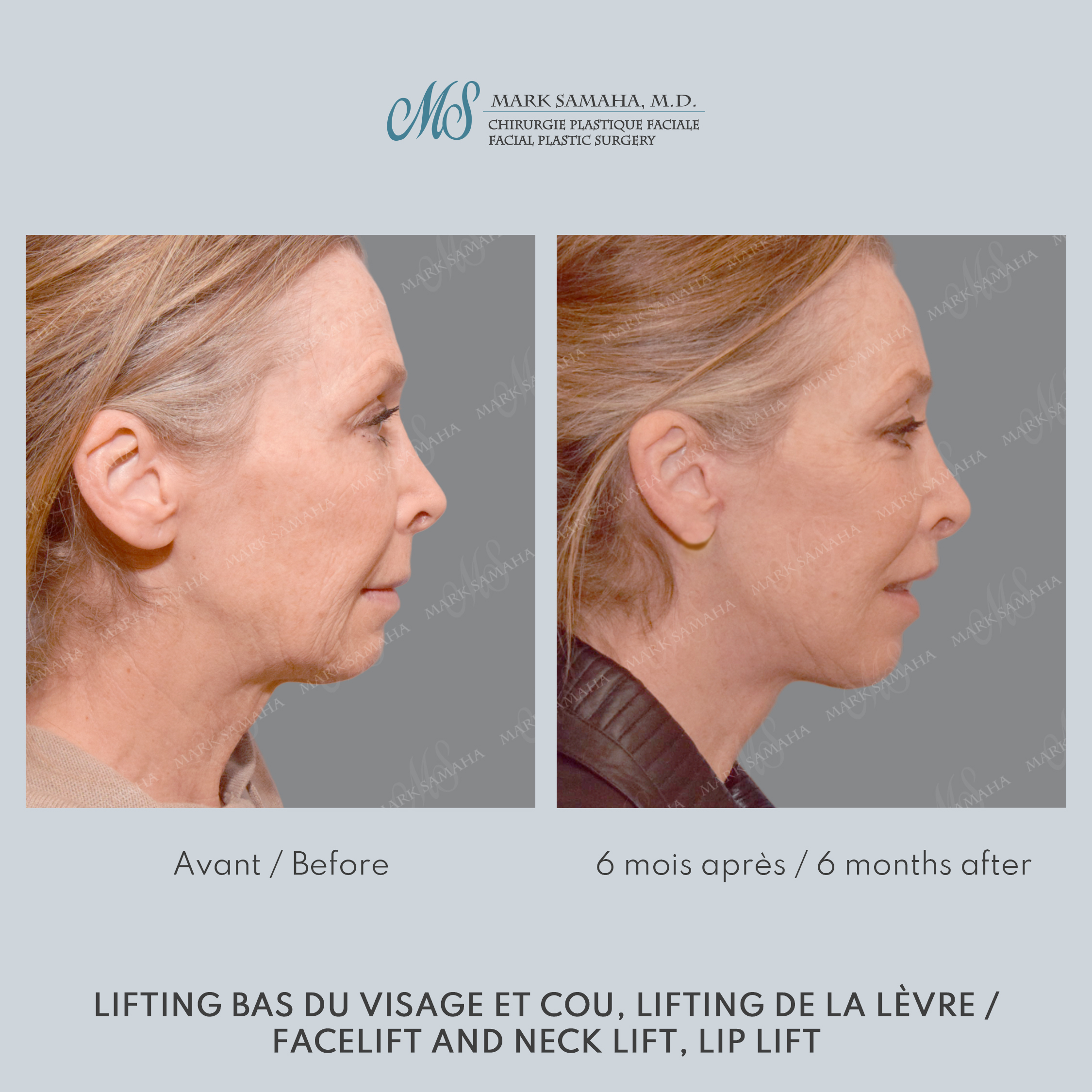 Before & After Lifting du visage / Cou - Facelift / Necklift Case 237 View #3 View in Montreal, QC