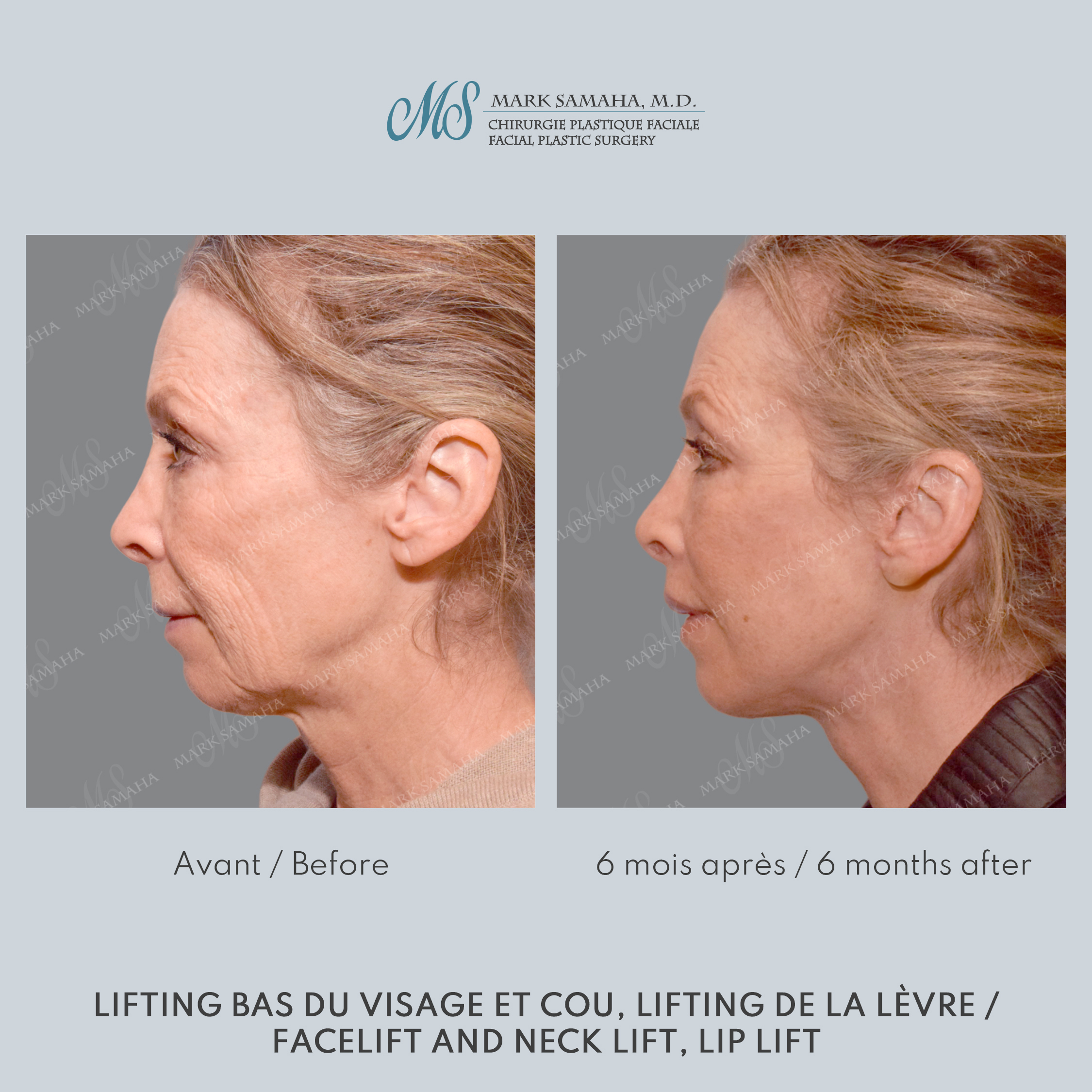 Before & After Lifting du visage / Cou - Facelift / Necklift Case 237 View #4 Detail View in Montreal, QC