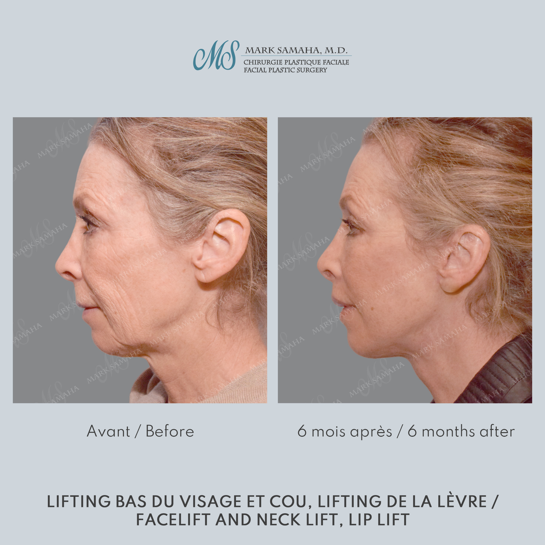 Before & After Lifting du visage / Cou - Facelift / Necklift Case 237 View #4 View in Montreal, QC