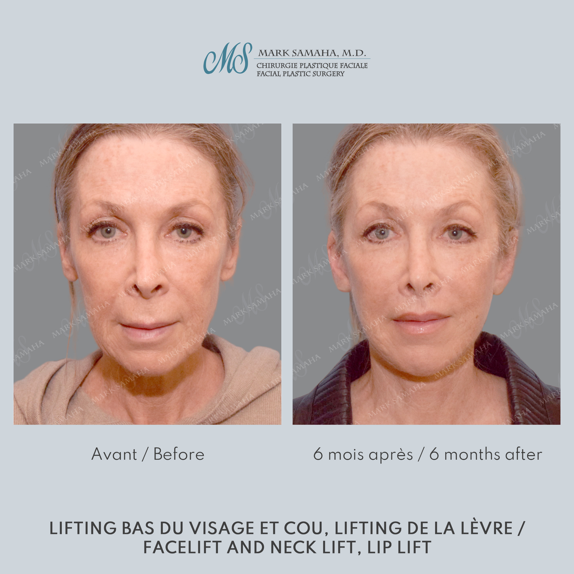 Before & After Lifting du visage / Cou - Facelift / Necklift Case 237 View #5 Detail View in Montreal, QC