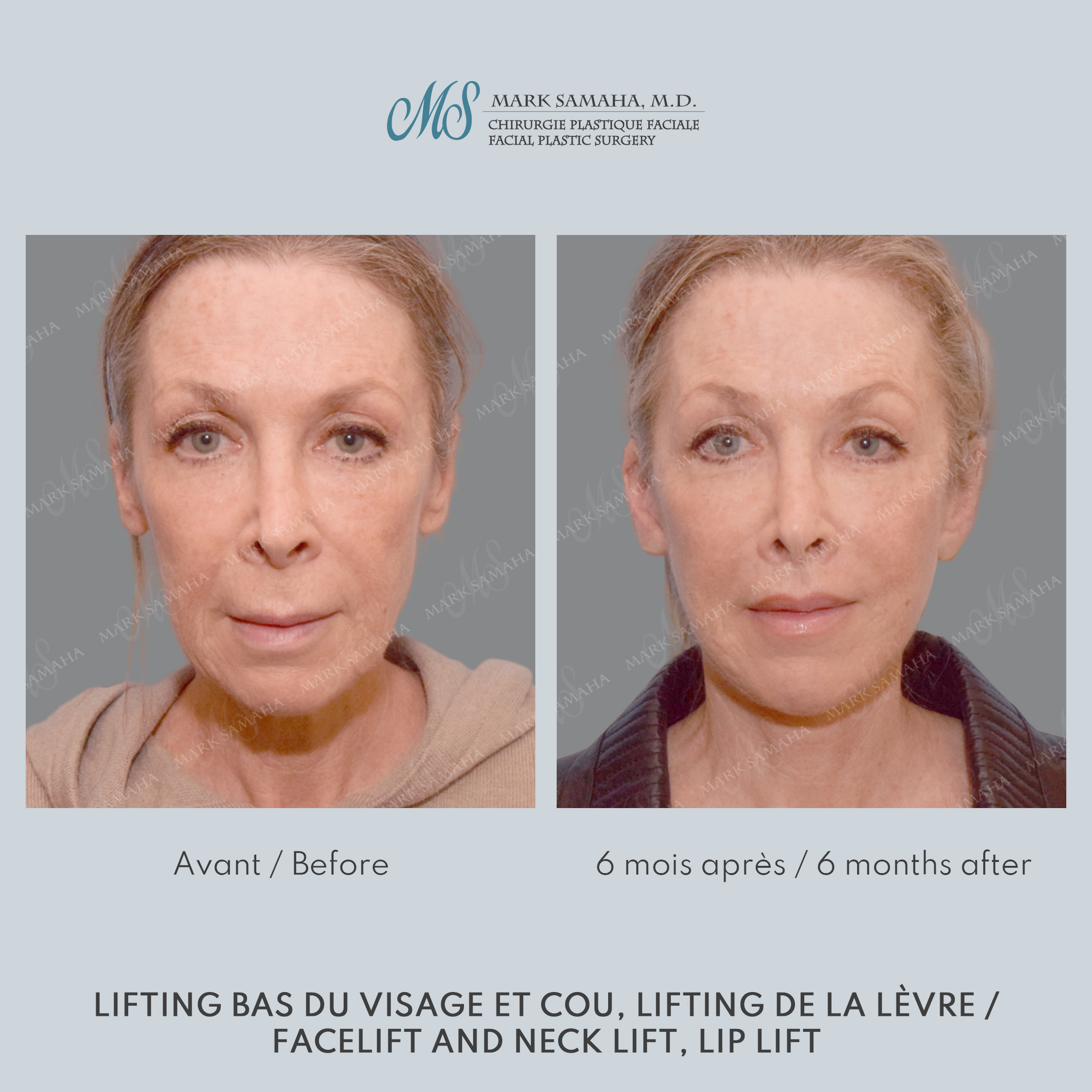 Before & After Lifting du visage / Cou - Facelift / Necklift Case 237 View #5 View in Montreal, QC