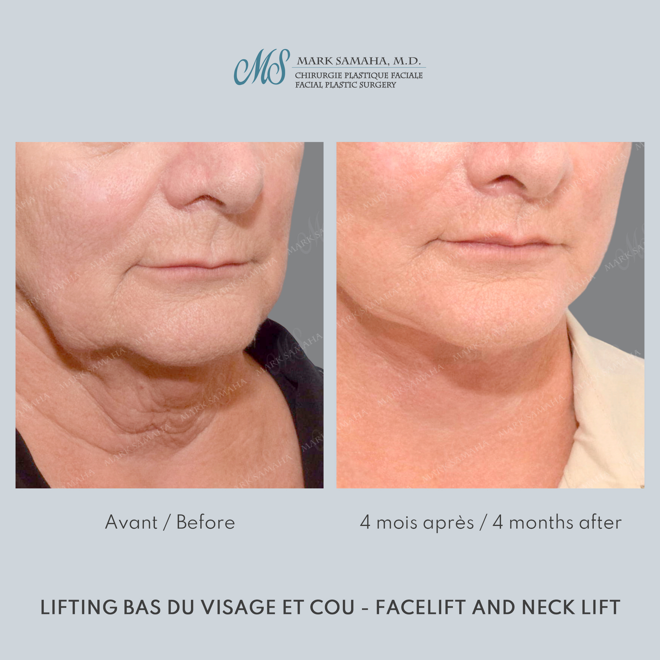 Before & After Lifting du visage / Cou - Facelift / Necklift Case 238 View #1 Detail View in Montreal, QC