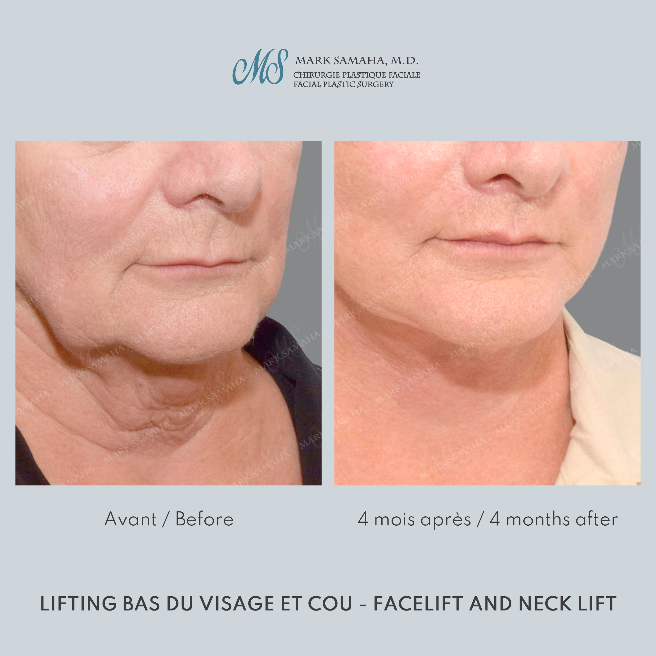 Before & After Lifting du visage / Cou - Facelift / Necklift Case 238 View #1 View in Montreal, QC