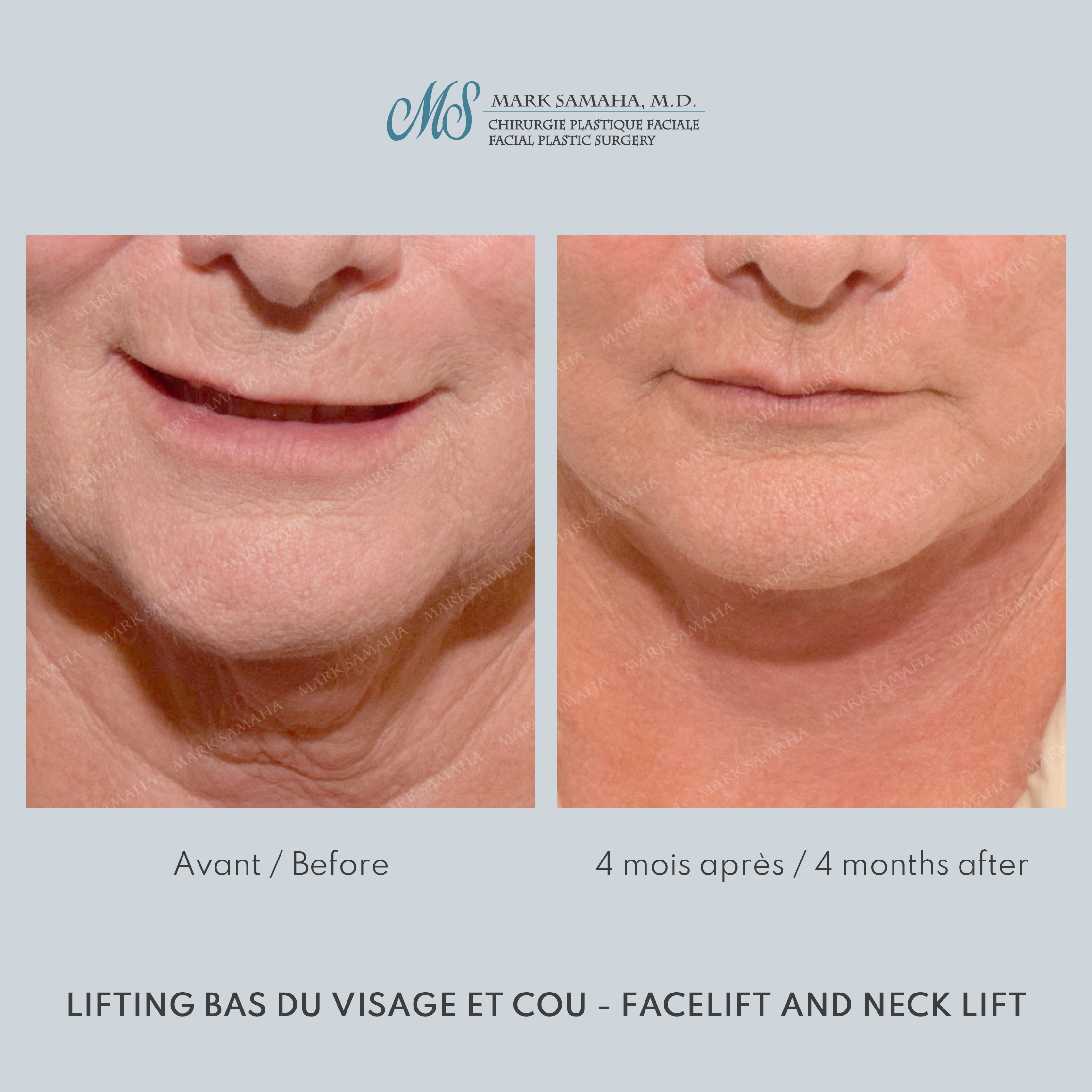Before & After Lifting du visage / Cou - Facelift / Necklift Case 238 View #2 View in Montreal, QC