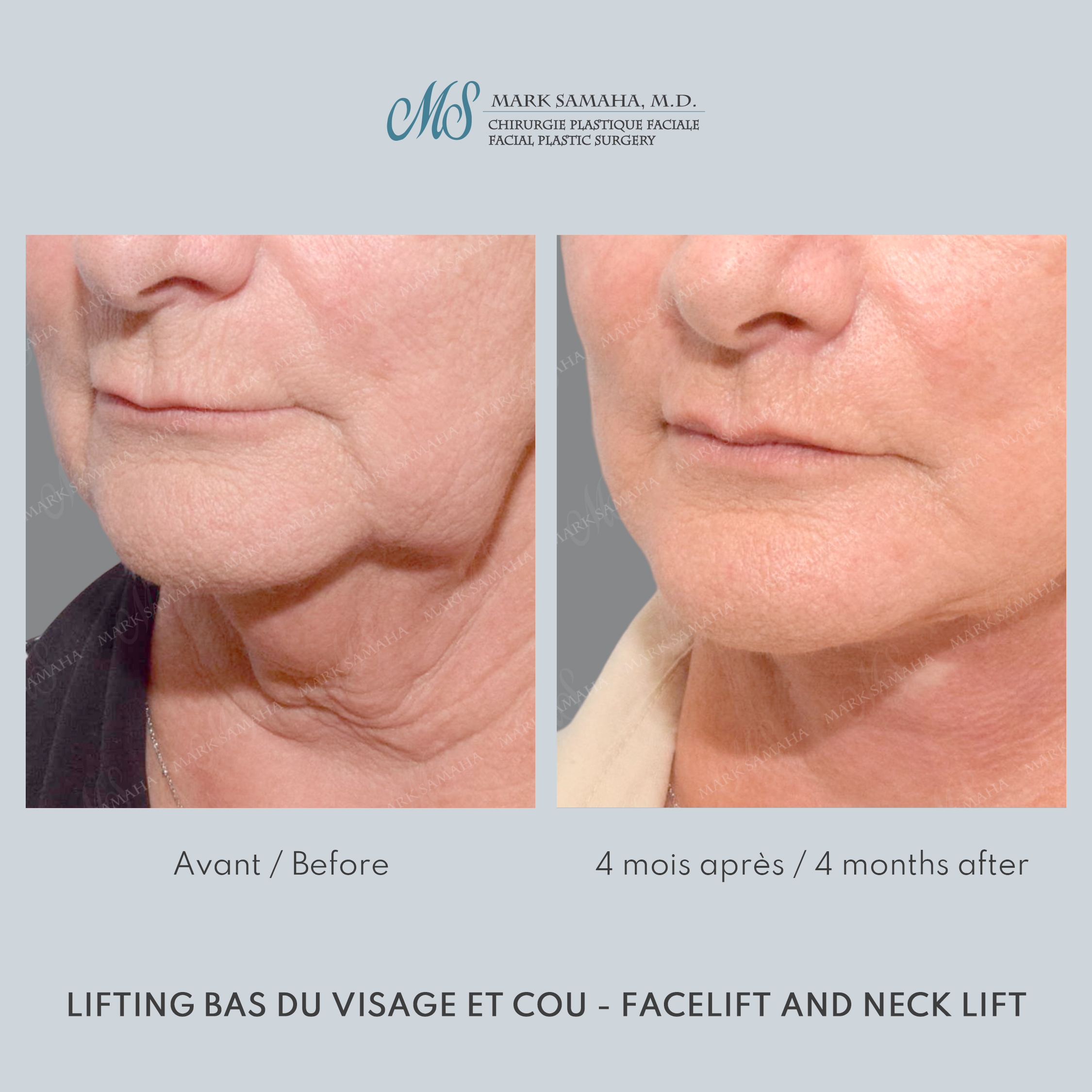 Before & After Lifting du visage / Cou - Facelift / Necklift Case 238 View #3 Detail View in Montreal, QC