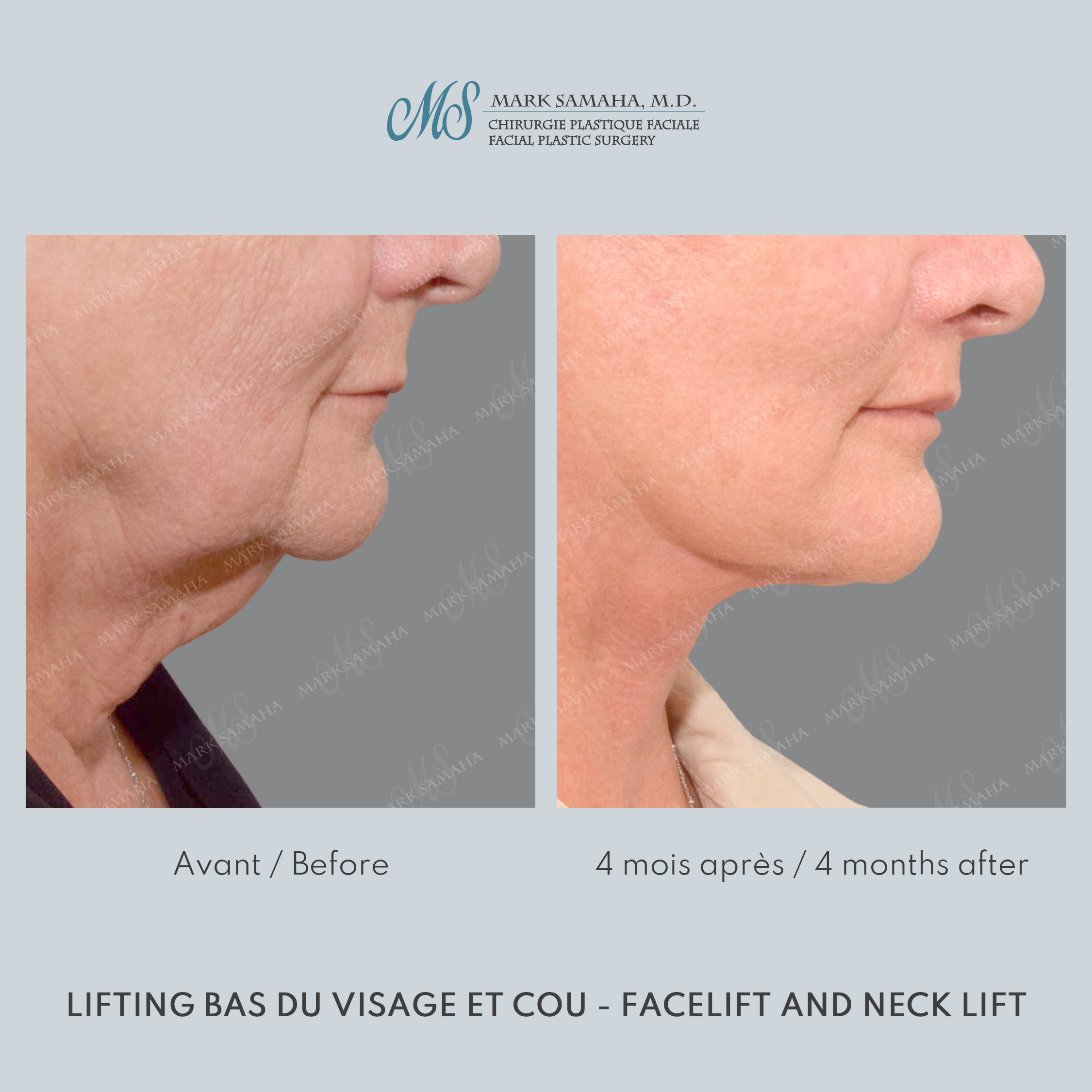 Before & After Lifting du visage / Cou - Facelift / Necklift Case 238 View #4 View in Montreal, QC