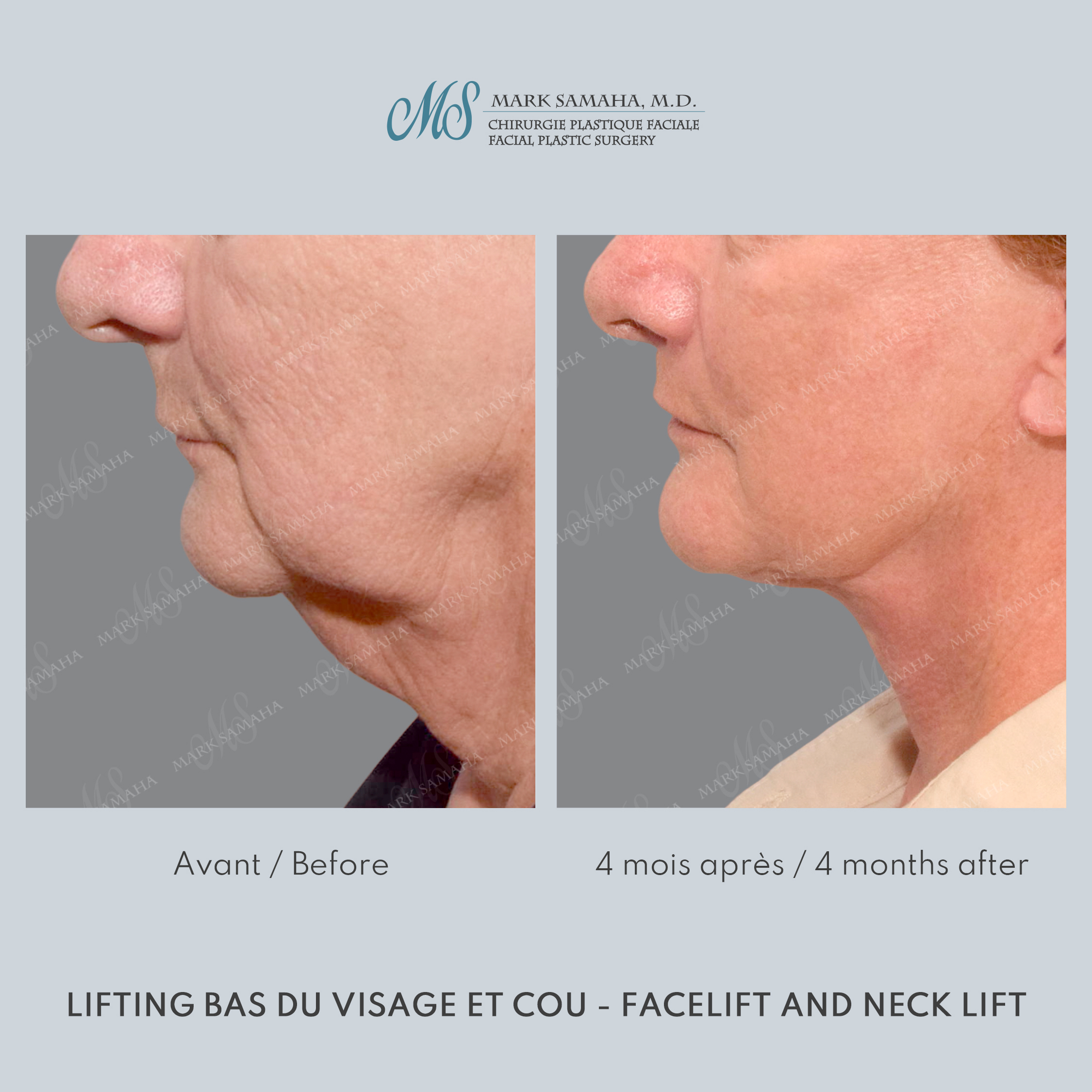 Before & After Lifting du visage / Cou - Facelift / Necklift Case 238 View #5 Detail View in Montreal, QC