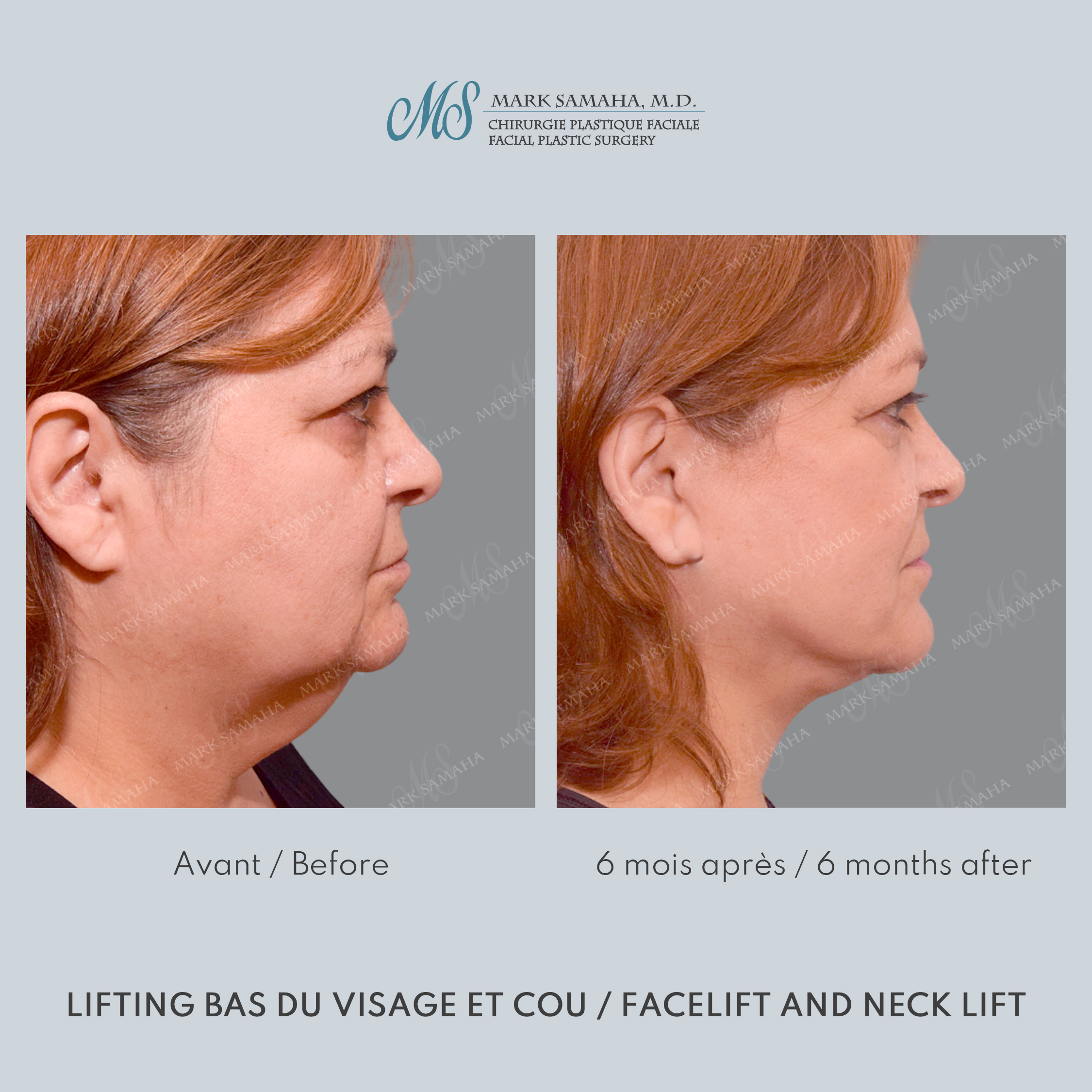 Before & After Lifting du visage / Cou - Facelift / Necklift Case 239 View #1 Detail View in Montreal, QC