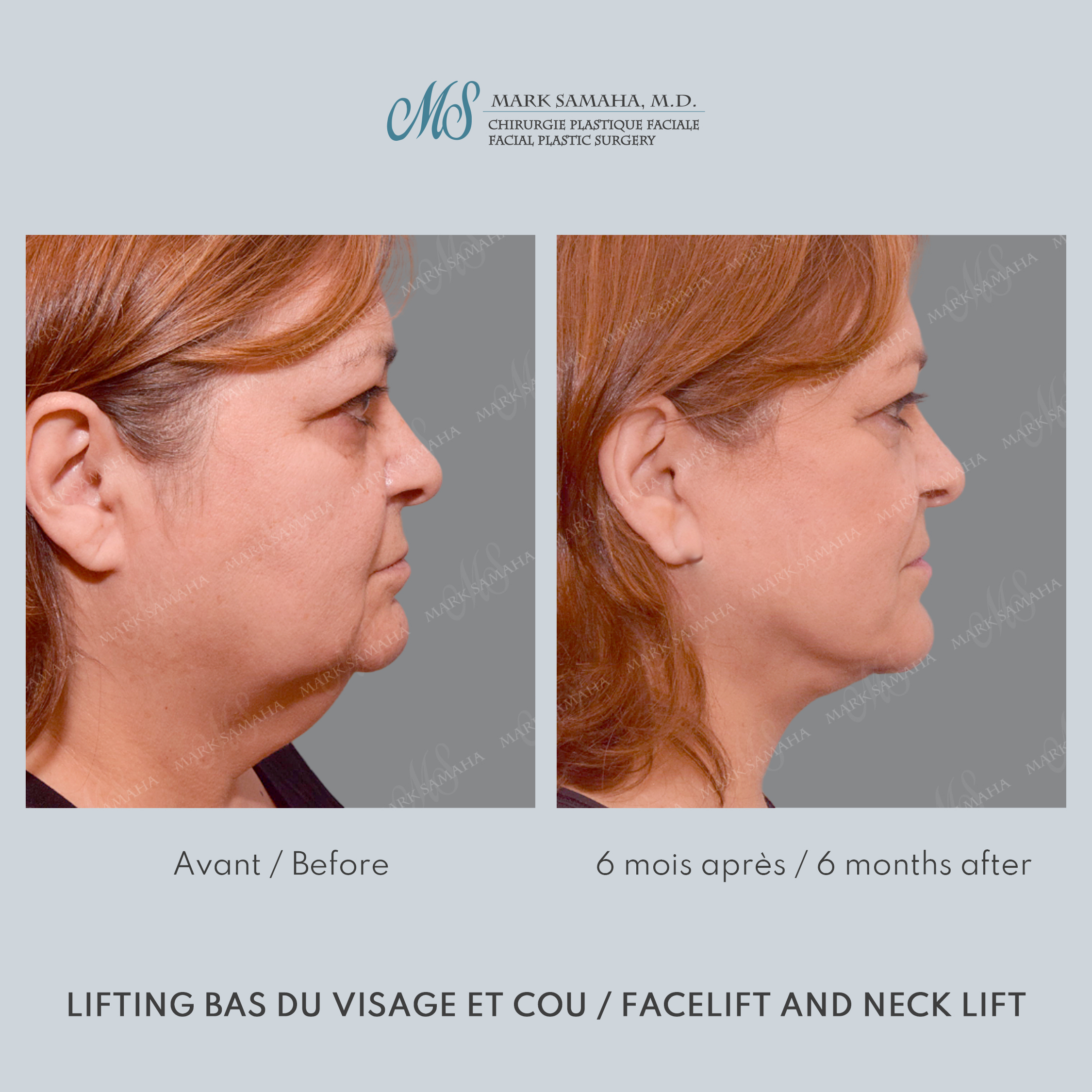 Before & After Lifting du visage / Cou - Facelift / Necklift Case 239 View #1 View in Montreal, QC