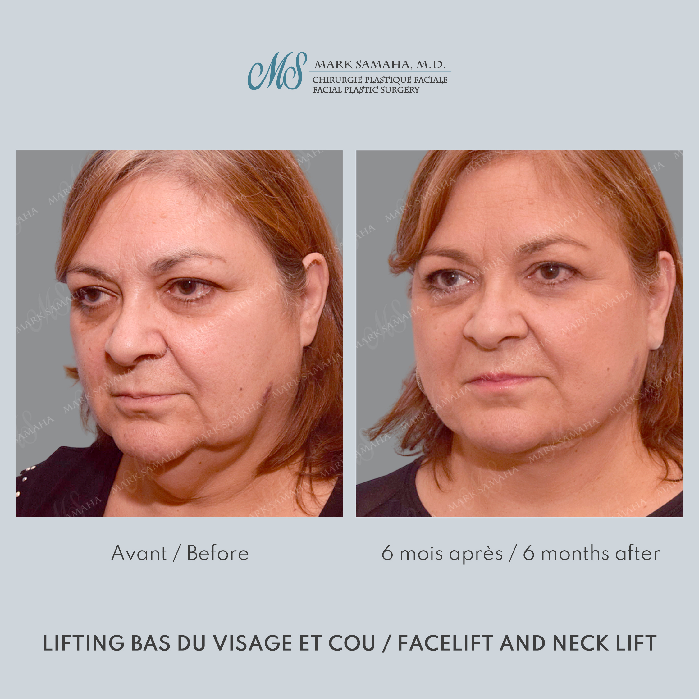 Before & After Lifting du visage / Cou - Facelift / Necklift Case 239 View #2 Detail View in Montreal, QC