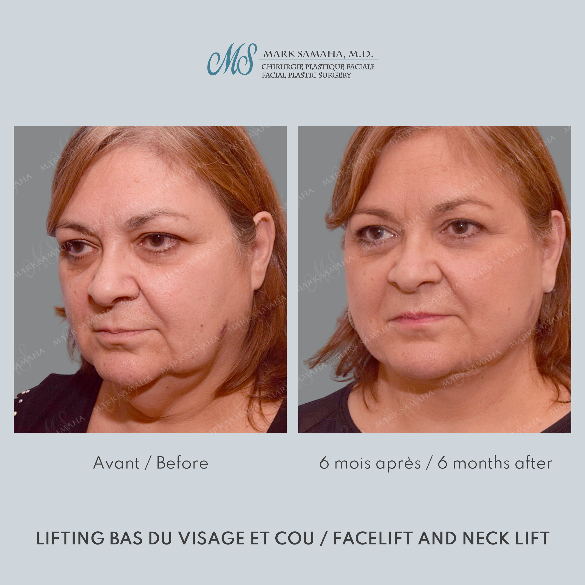Before & After Lifting du visage / Cou - Facelift / Necklift Case 239 View #2 View in Montreal, QC