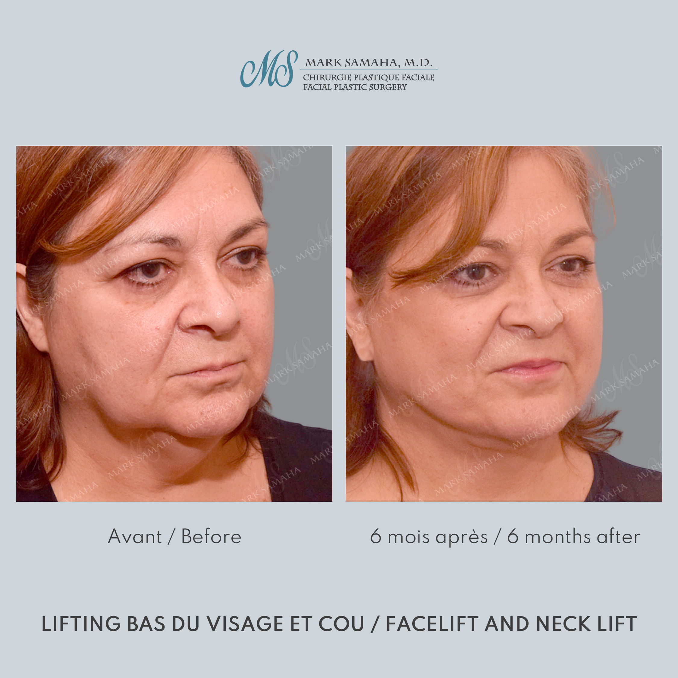 Before & After Lifting du visage / Cou - Facelift / Necklift Case 239 View #3 Detail View in Montreal, QC