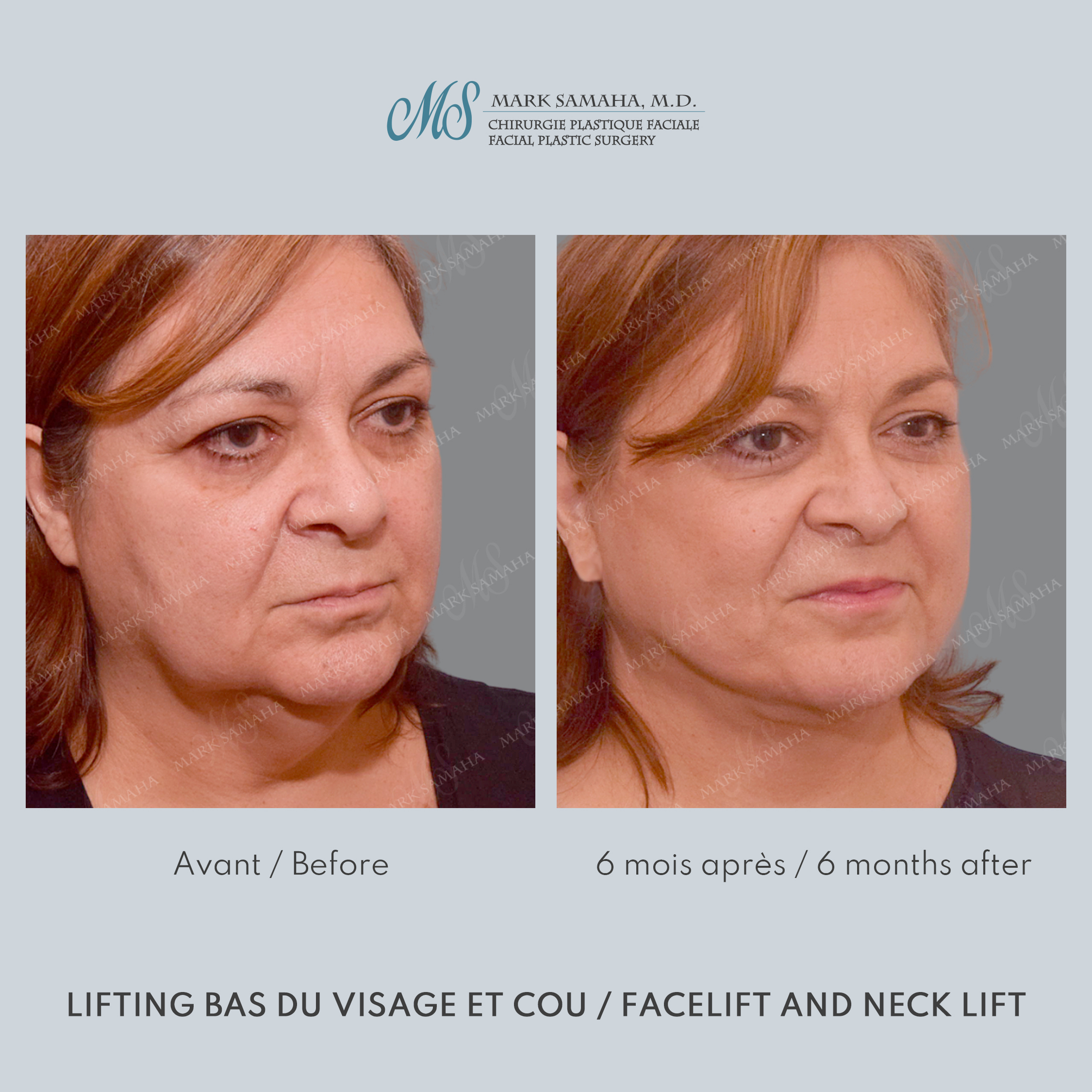 Before & After Lifting du visage / Cou - Facelift / Necklift Case 239 View #3 View in Montreal, QC