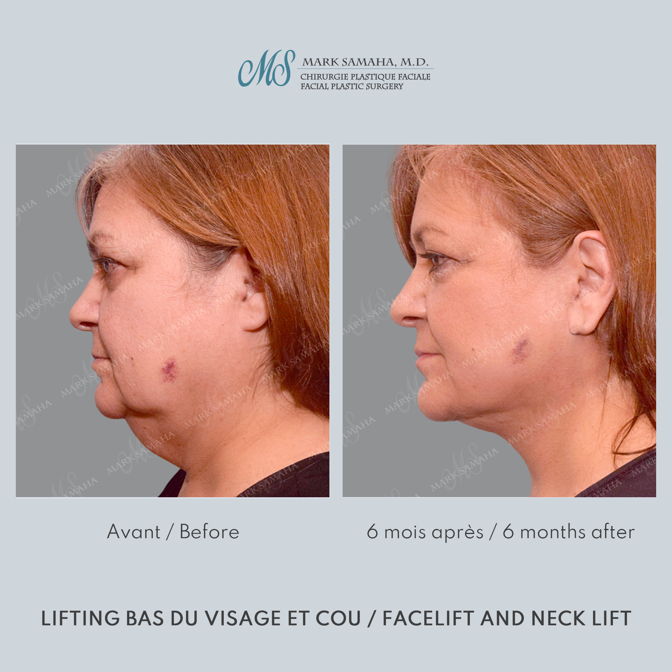 Before & After Lifting du visage / Cou - Facelift / Necklift Case 239 View #4 Detail View in Montreal, QC