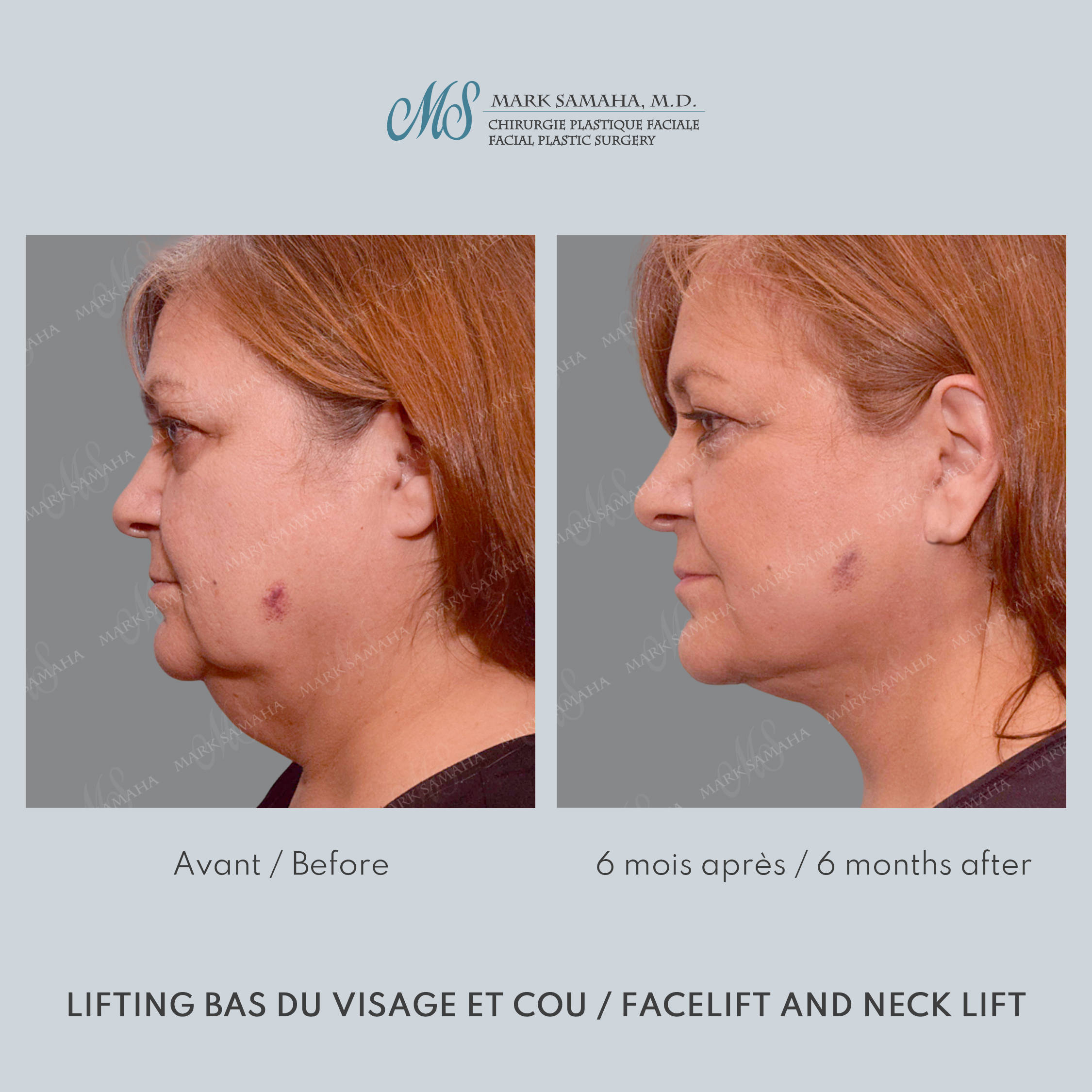 Before & After Lifting du visage / Cou - Facelift / Necklift Case 239 View #4 View in Montreal, QC