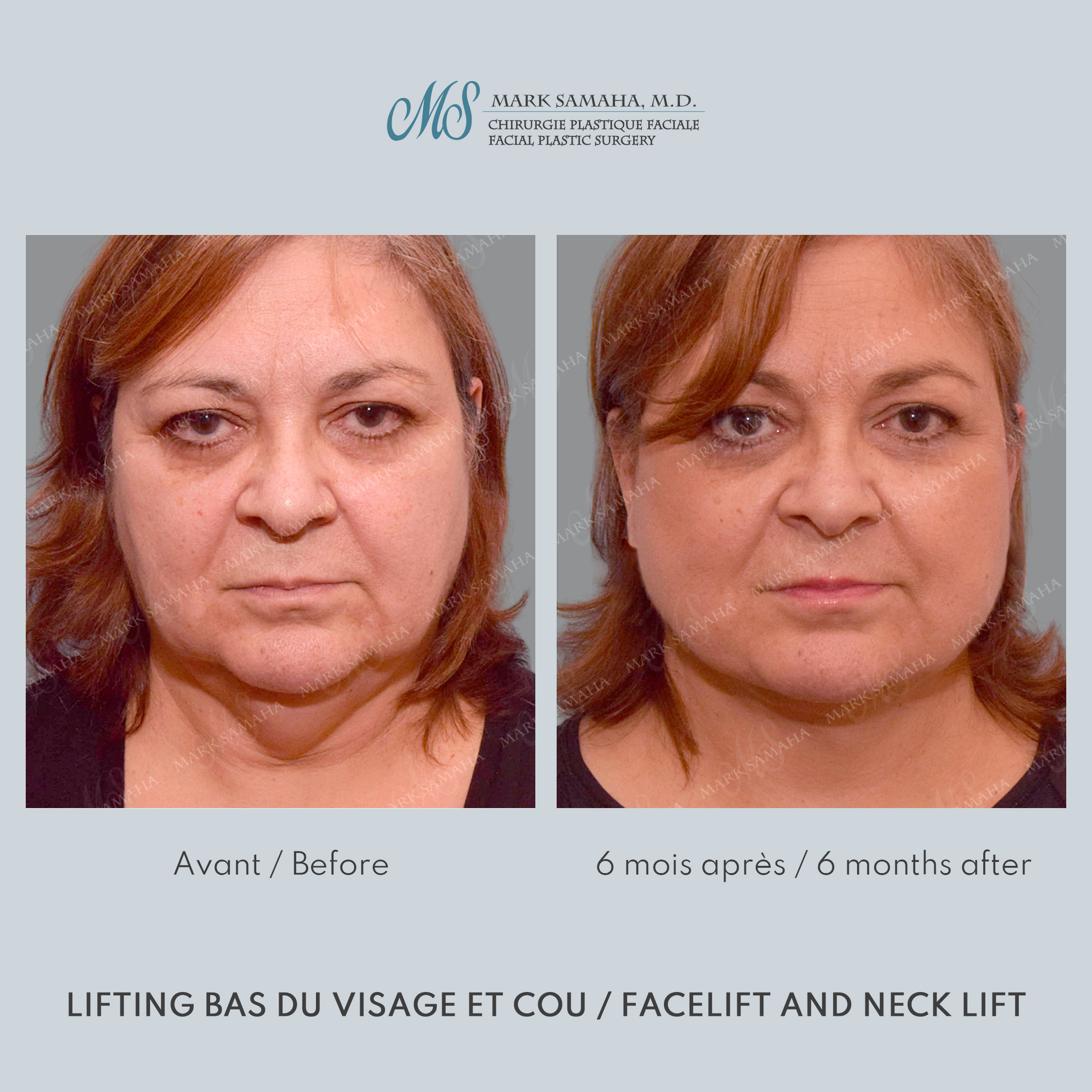 Before & After Lifting du visage / Cou - Facelift / Necklift Case 239 View #5 Detail View in Montreal, QC