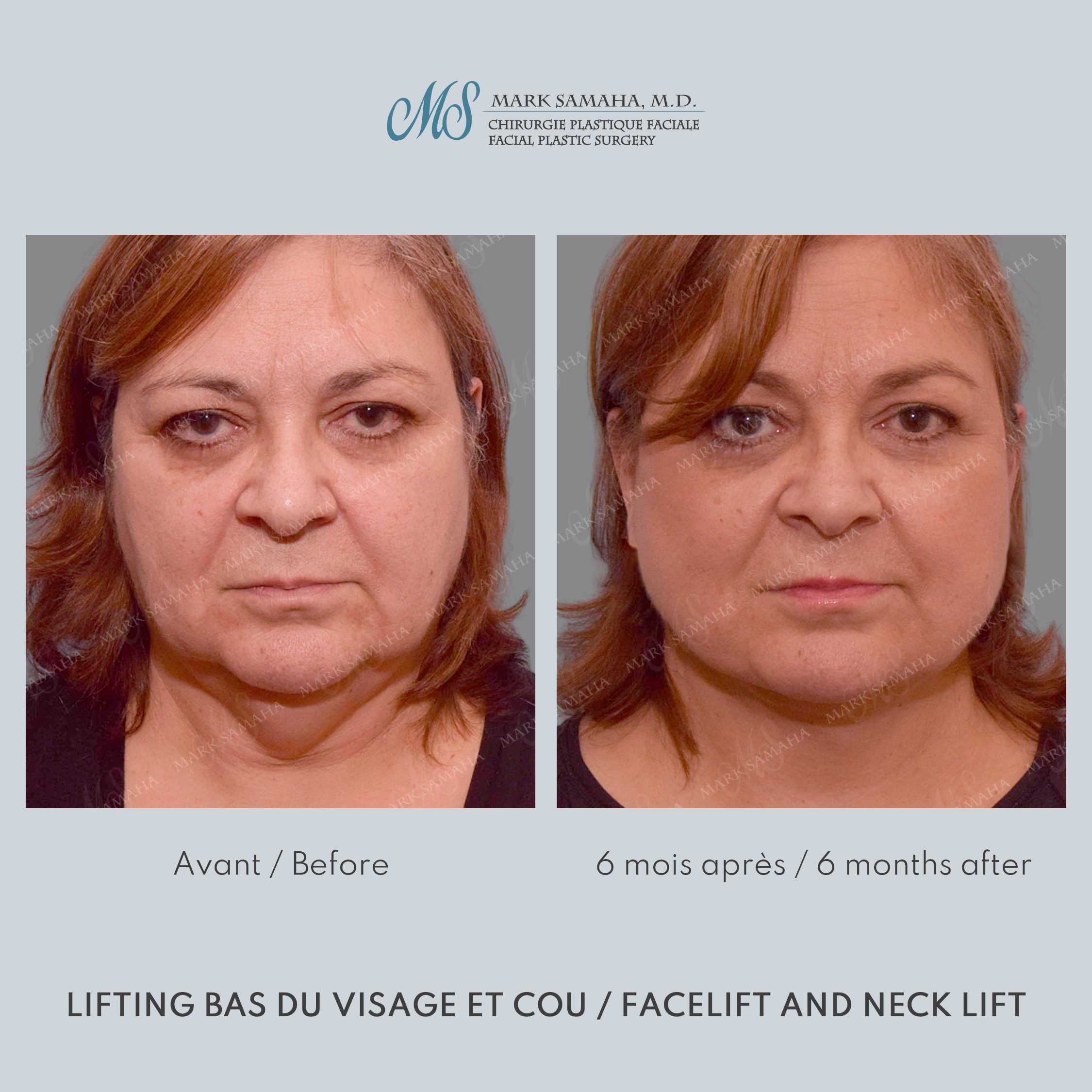 Before & After Lifting du visage / Cou - Facelift / Necklift Case 239 View #5 View in Montreal, QC
