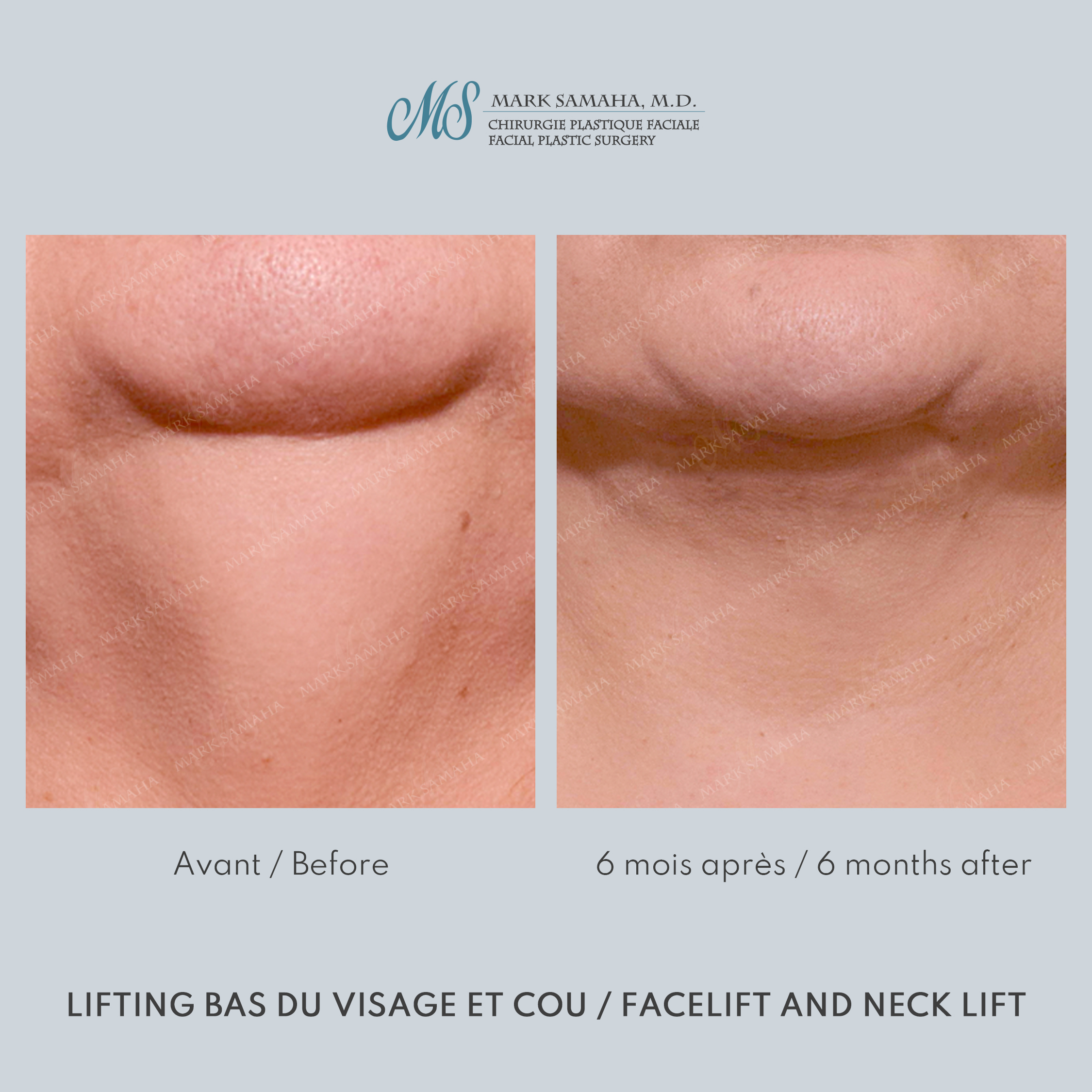 Before & After Lifting du visage / Cou - Facelift / Necklift Case 239 View #6 View in Montreal, QC