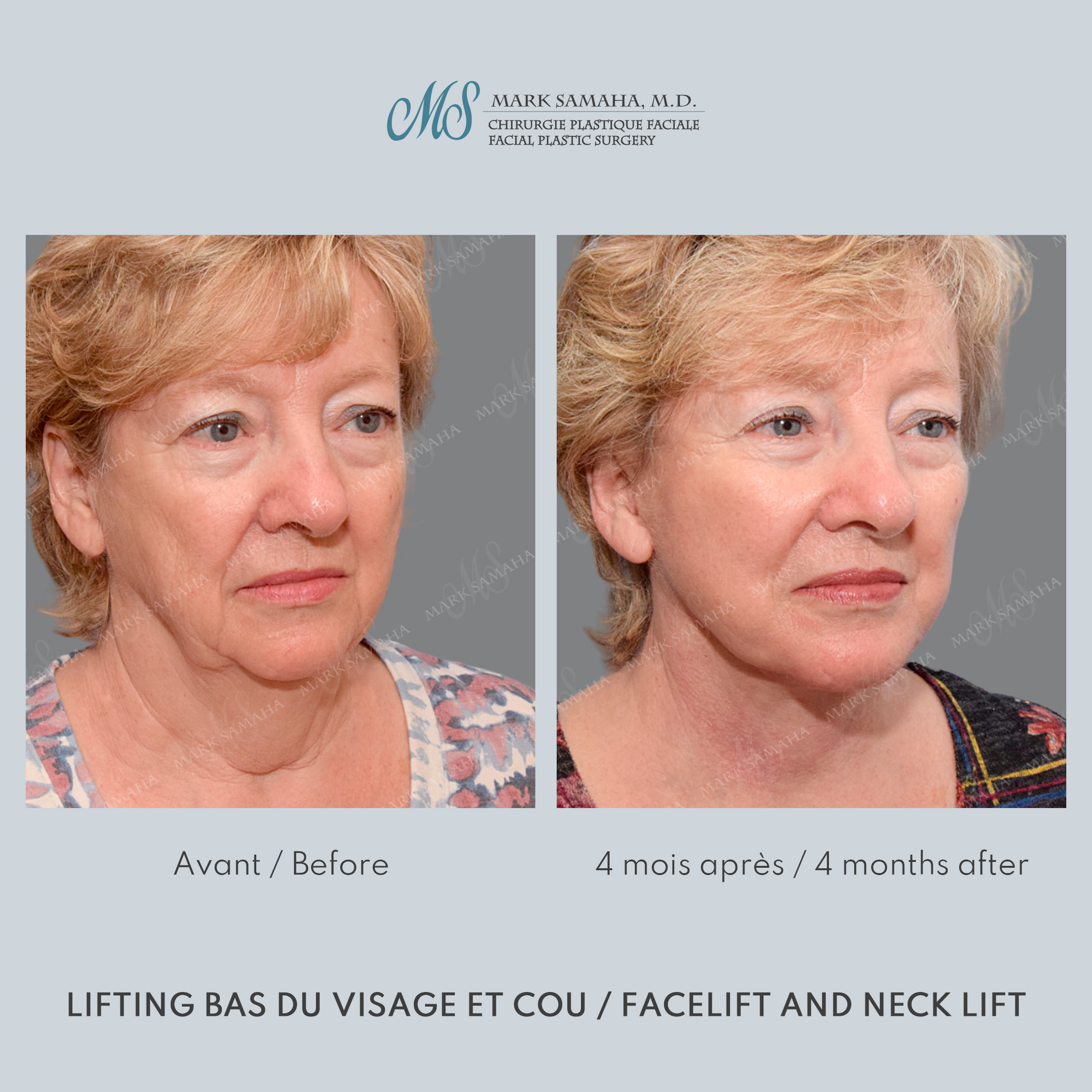 Before & After Lifting du visage / Cou - Facelift / Necklift Case 240 View #1 Detail View in Montreal, QC