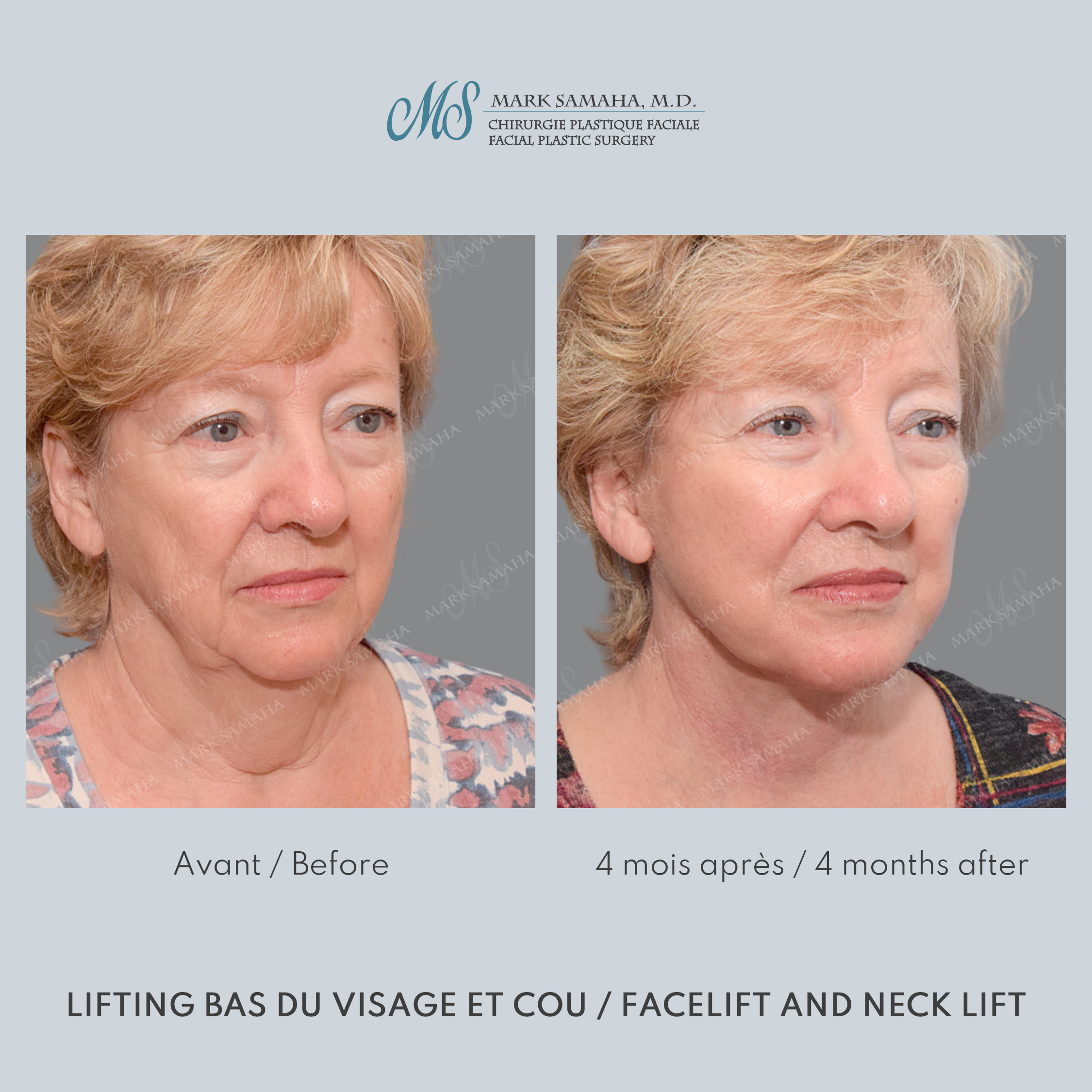 Before & After Lifting du visage / Cou - Facelift / Necklift Case 240 View #1 View in Montreal, QC