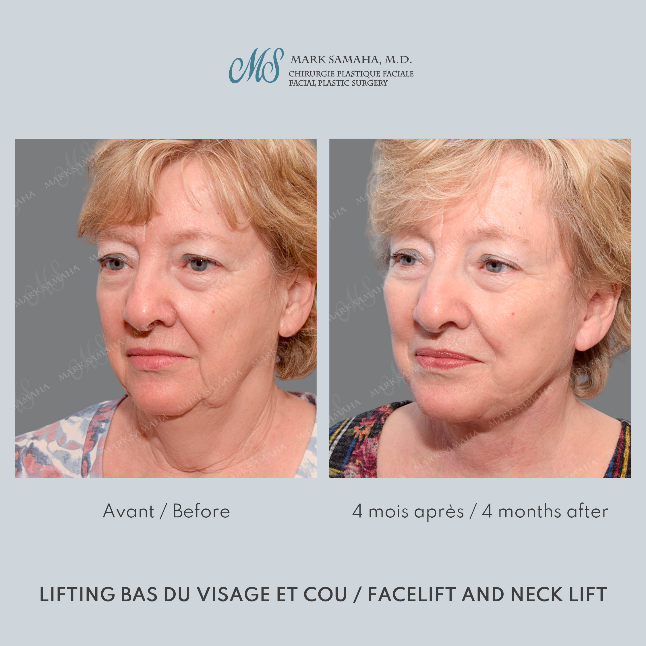 Before & After Lifting du visage / Cou - Facelift / Necklift Case 240 View #2 Detail View in Montreal, QC