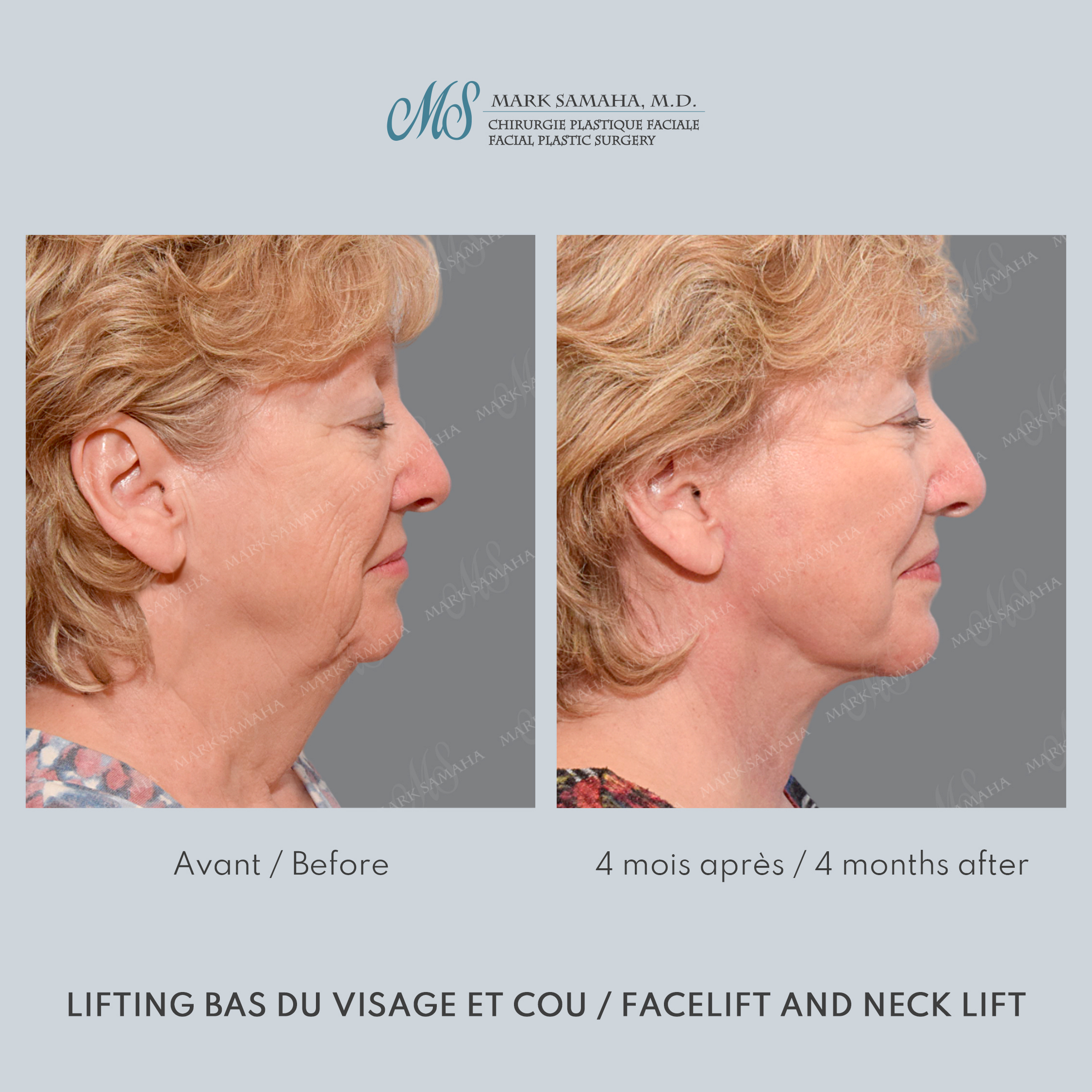Before & After Lifting du visage / Cou - Facelift / Necklift Case 240 View #3 Detail View in Montreal, QC