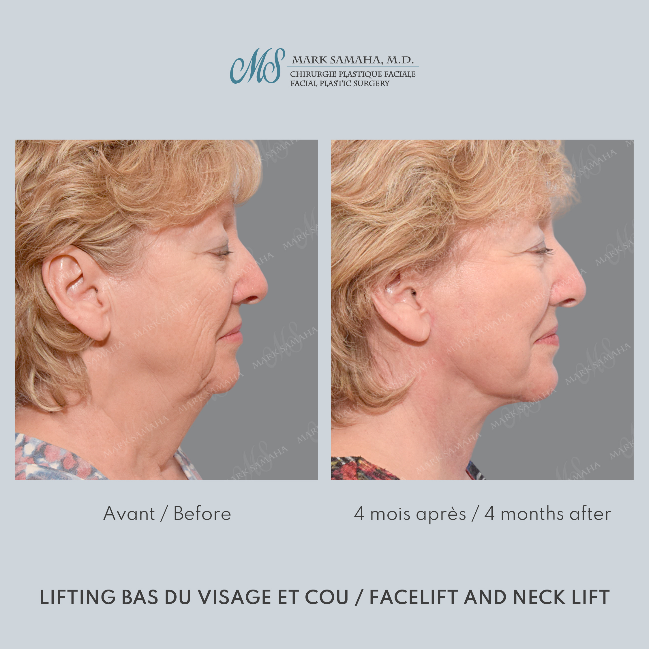 Before & After Lifting du visage / Cou - Facelift / Necklift Case 240 View #3 View in Montreal, QC