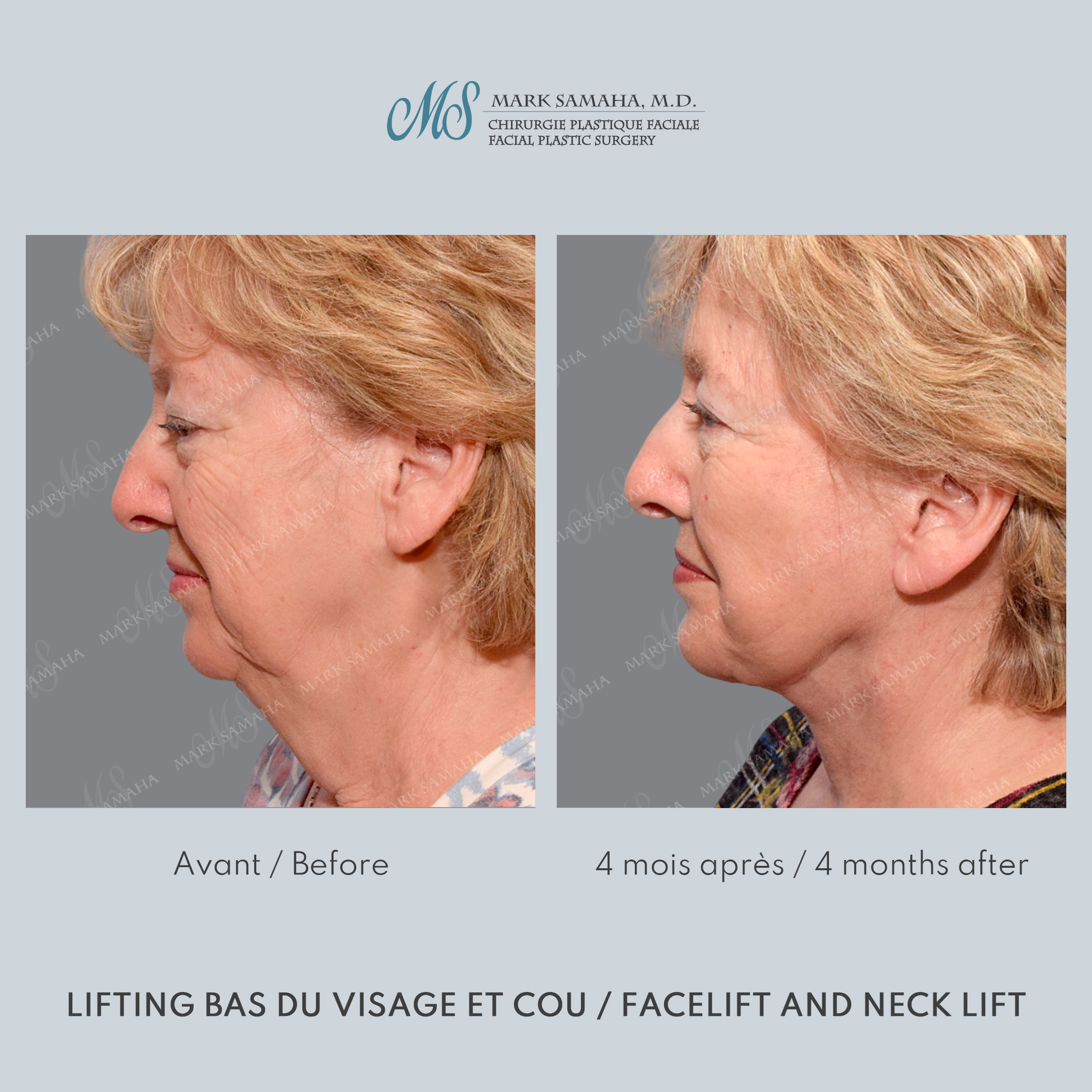 Before & After Lifting du visage / Cou - Facelift / Necklift Case 240 View #4 Detail View in Montreal, QC