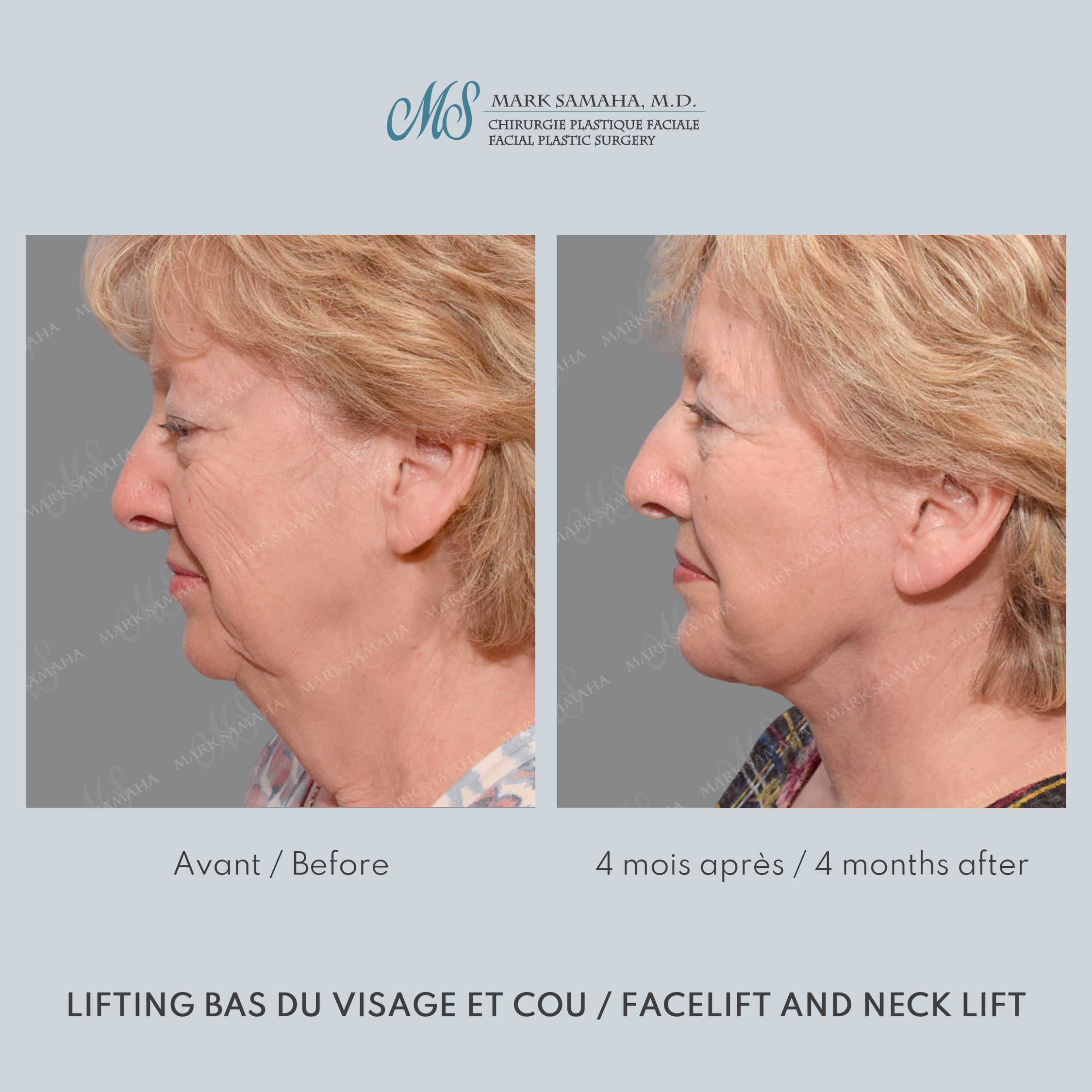 Before & After Lifting du visage / Cou - Facelift / Necklift Case 240 View #4 View in Montreal, QC