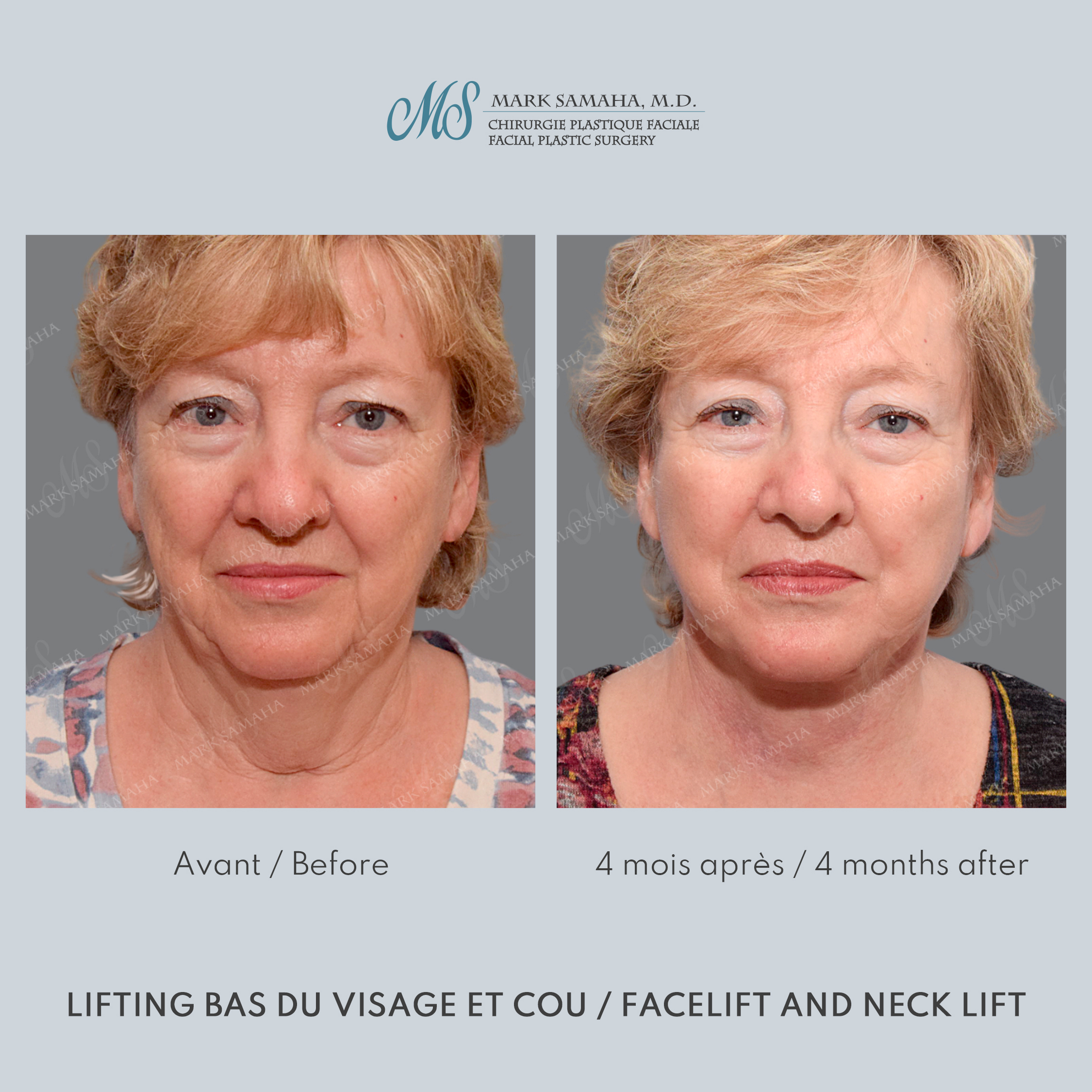 Before & After Lifting du visage / Cou - Facelift / Necklift Case 240 View #5 Detail View in Montreal, QC