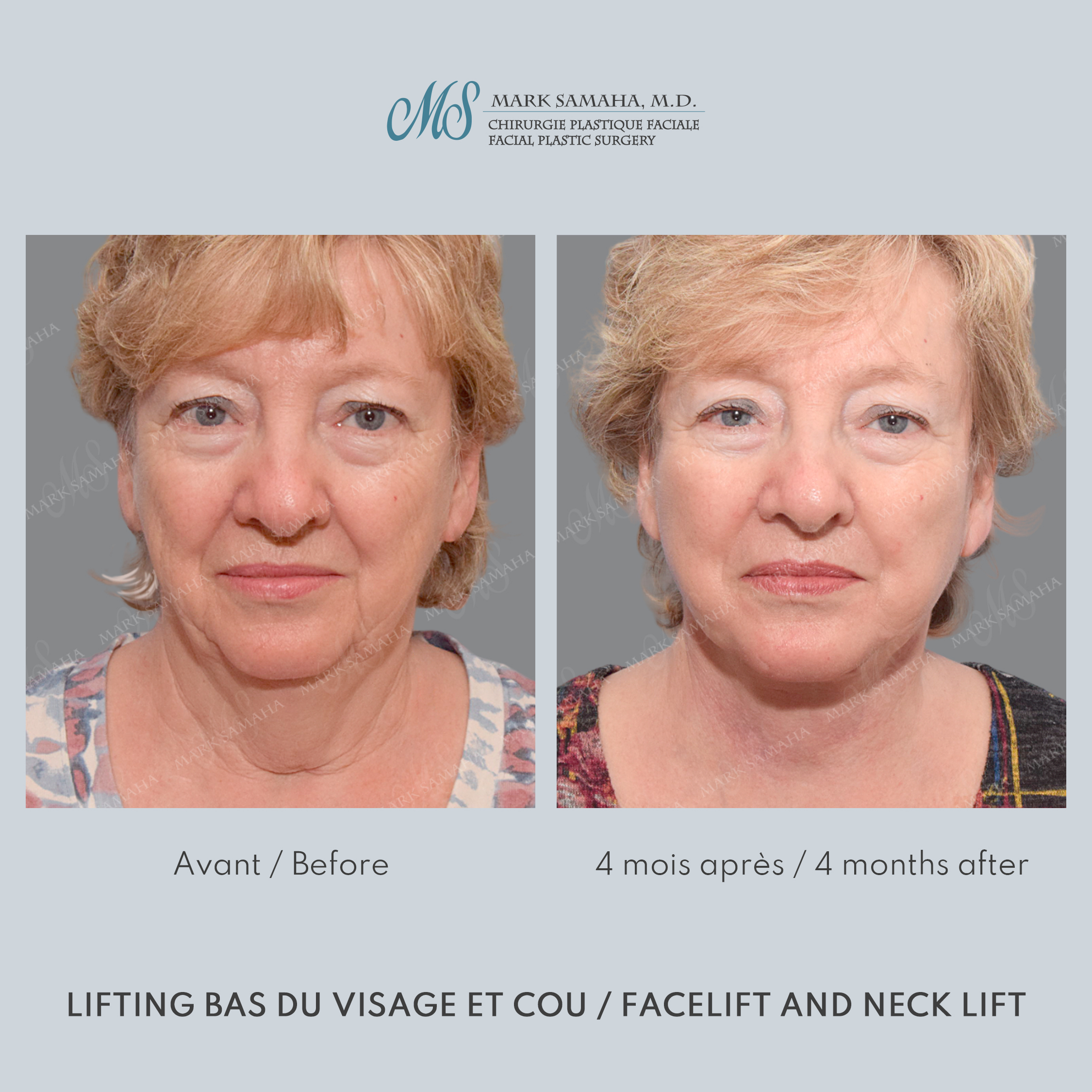 Before & After Lifting du visage / Cou - Facelift / Necklift Case 240 View #5 View in Montreal, QC