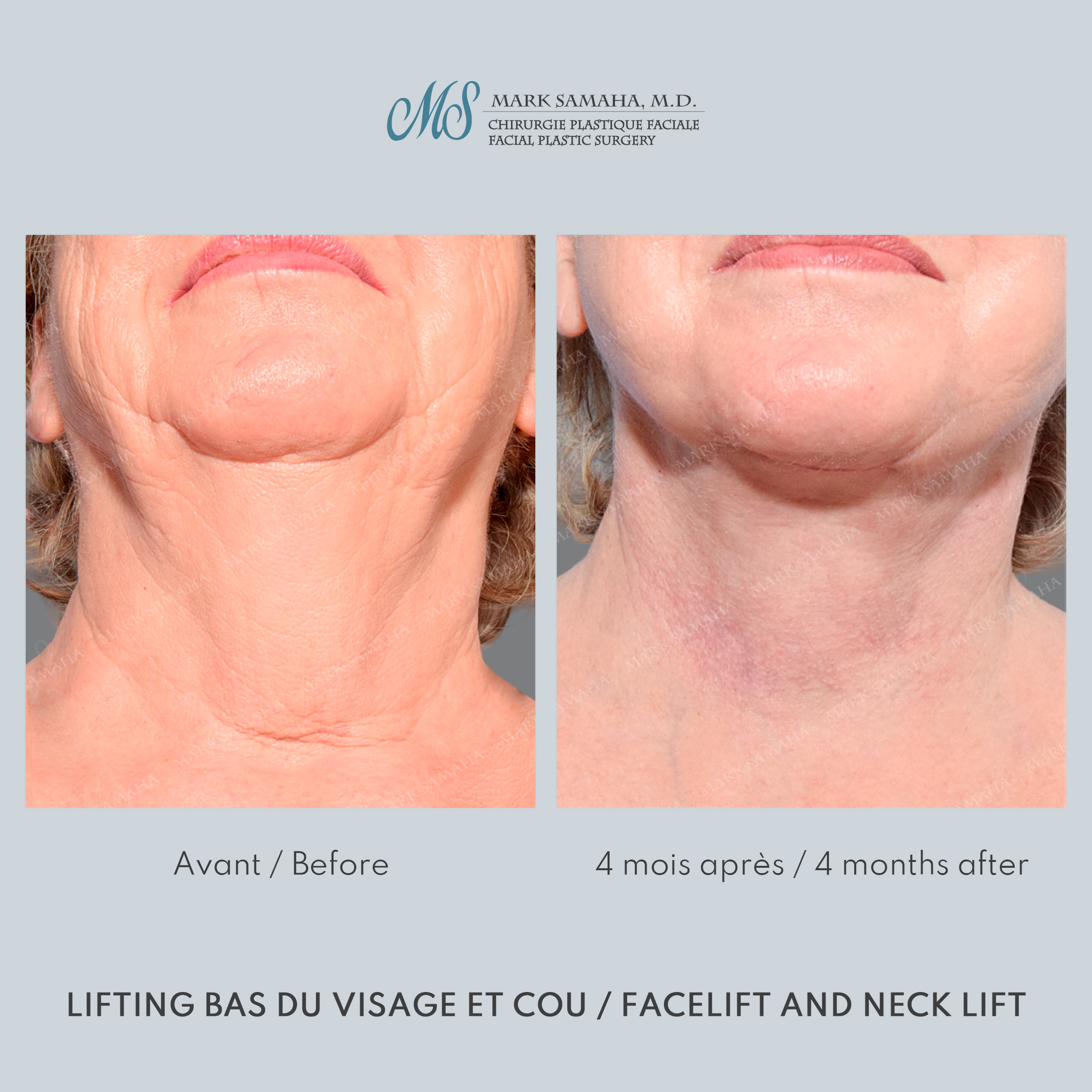 Before & After Lifting du visage / Cou - Facelift / Necklift Case 240 View #6 Detail View in Montreal, QC