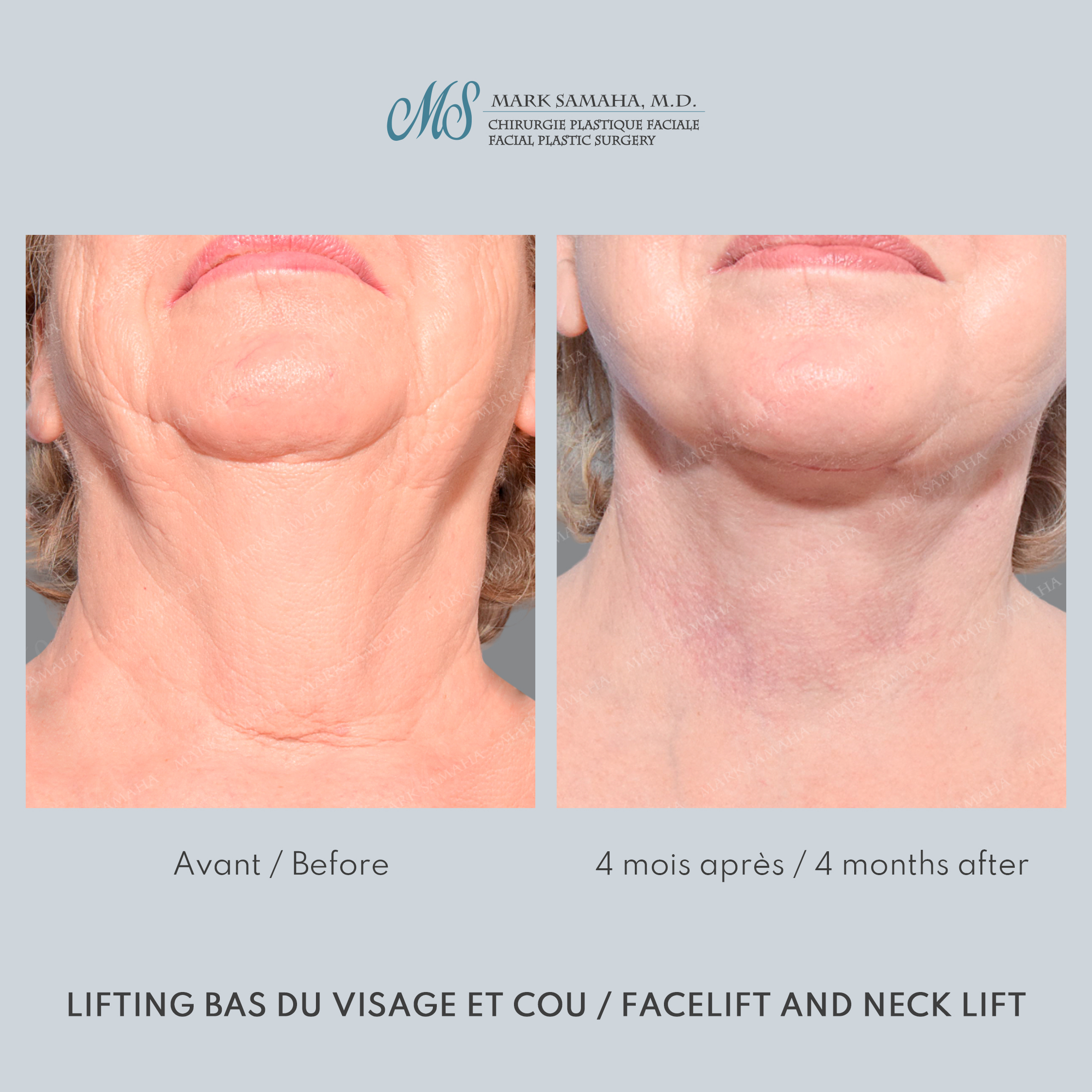 Before & After Lifting du visage / Cou - Facelift / Necklift Case 240 View #6 View in Montreal, QC