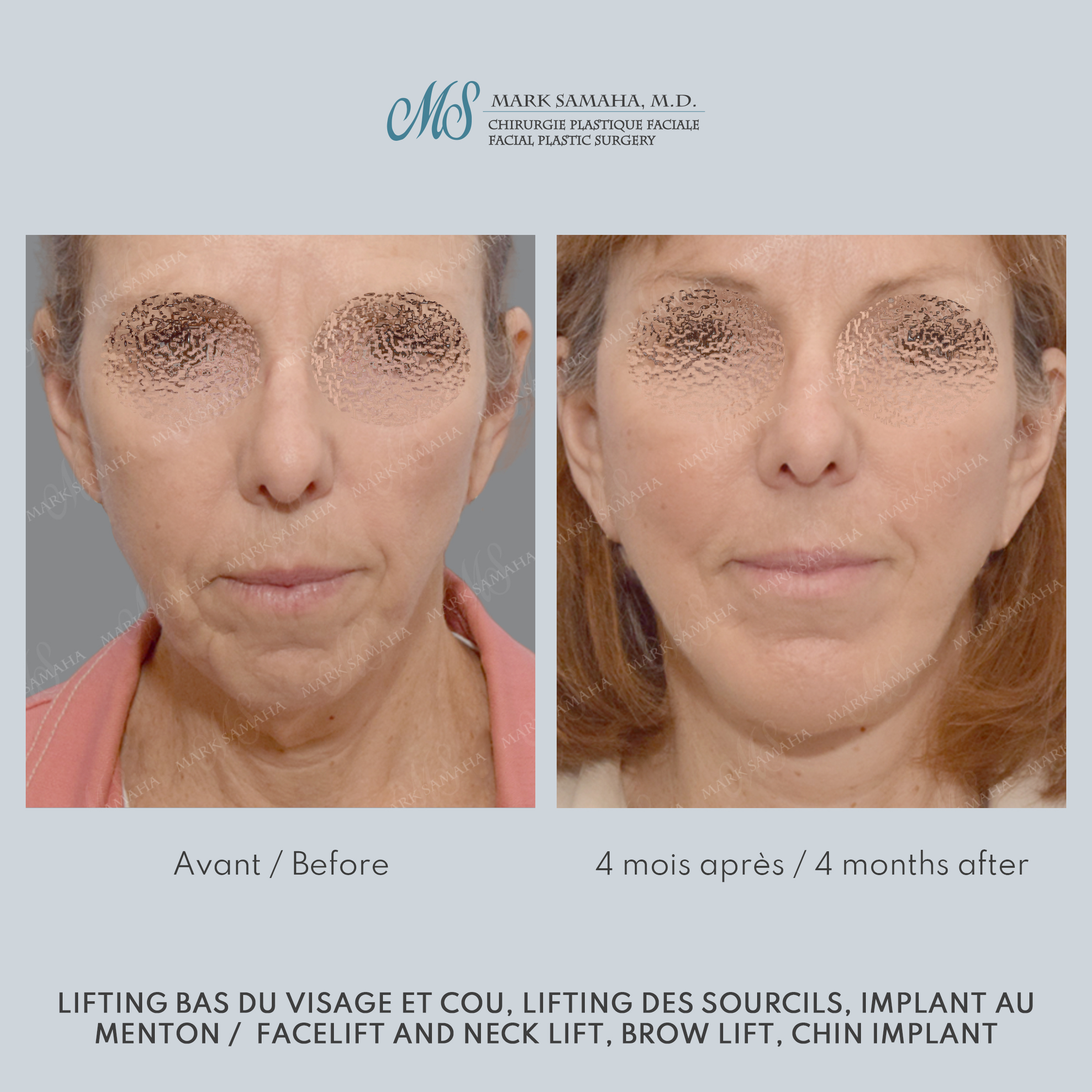 Before & After Lifting du visage / Cou - Facelift / Necklift Case 241 View #1 Detail View in Montreal, QC