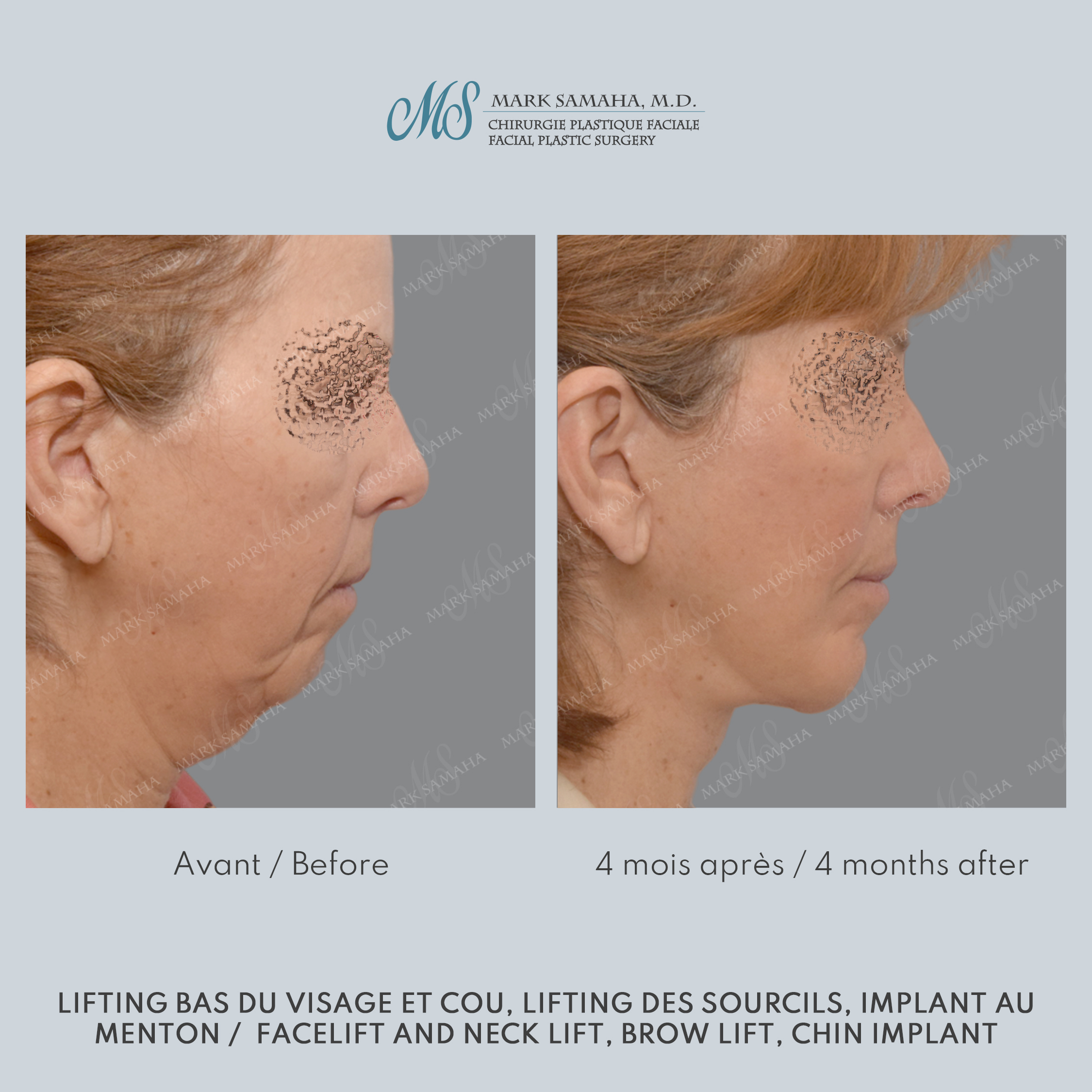 Before & After Lifting du visage / Cou - Facelift / Necklift Case 241 View #2 Detail View in Montreal, QC
