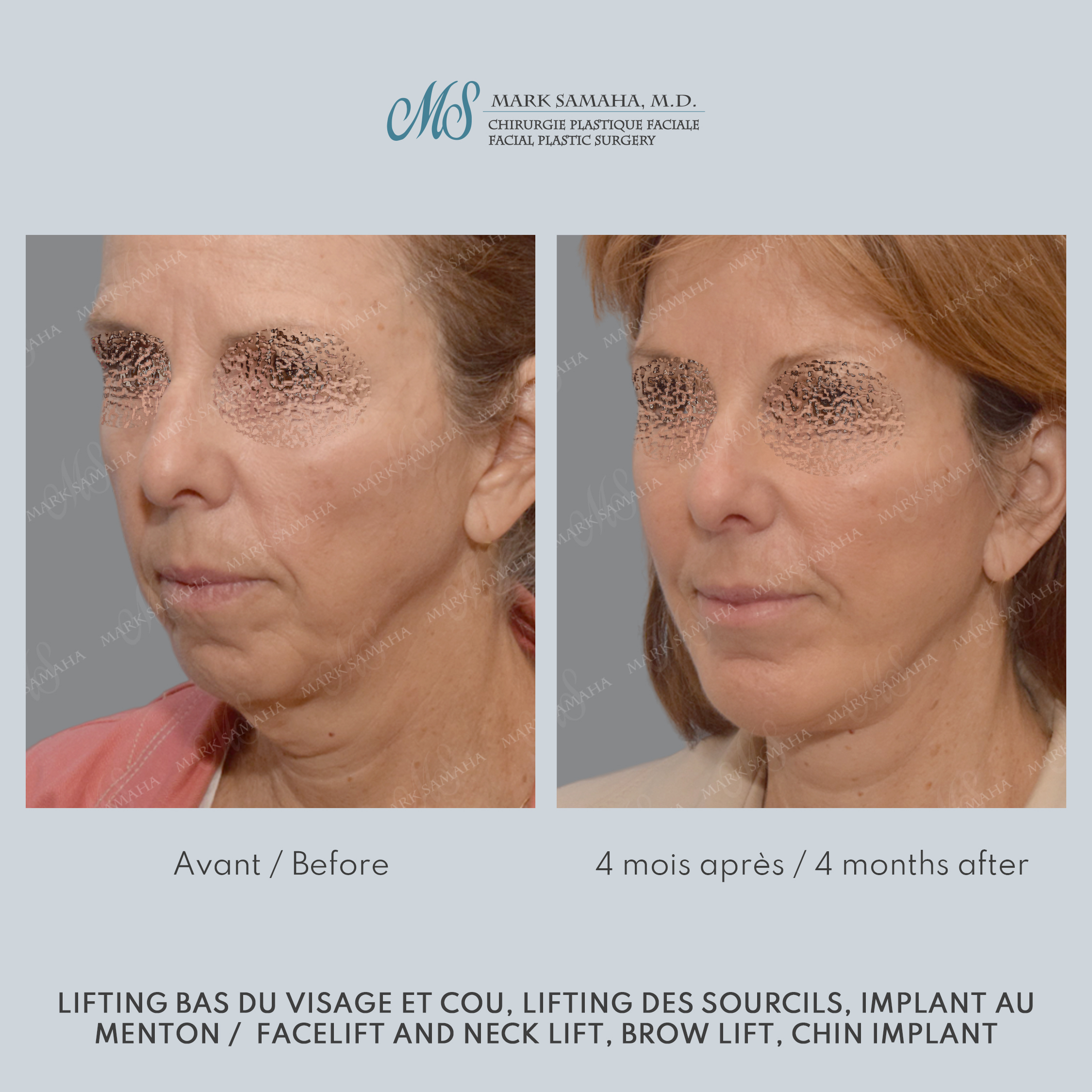 Before & After Lifting du visage / Cou - Facelift / Necklift Case 241 View #3 Detail View in Montreal, QC
