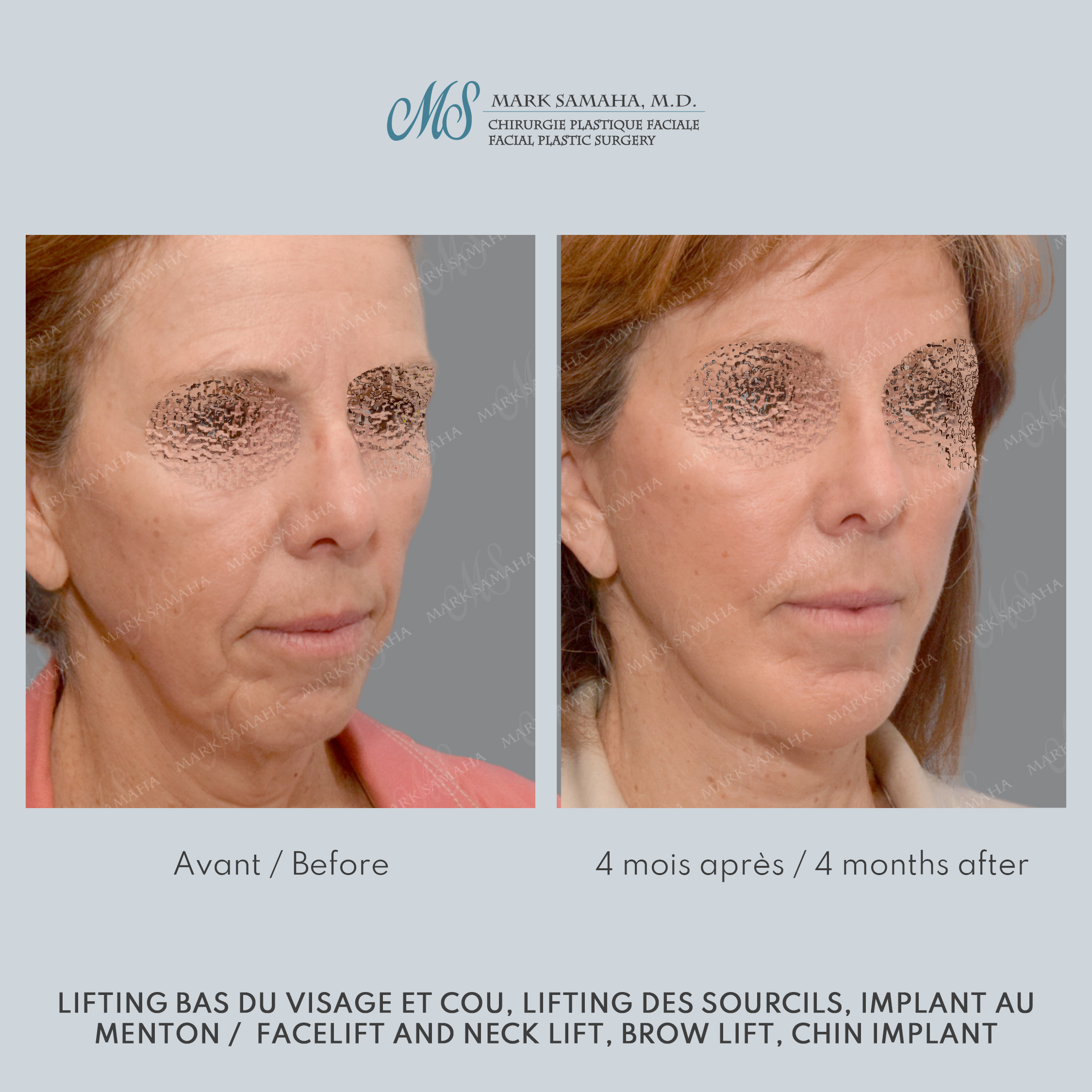 Before & After Lifting du visage / Cou - Facelift / Necklift Case 241 View #4 Detail View in Montreal, QC