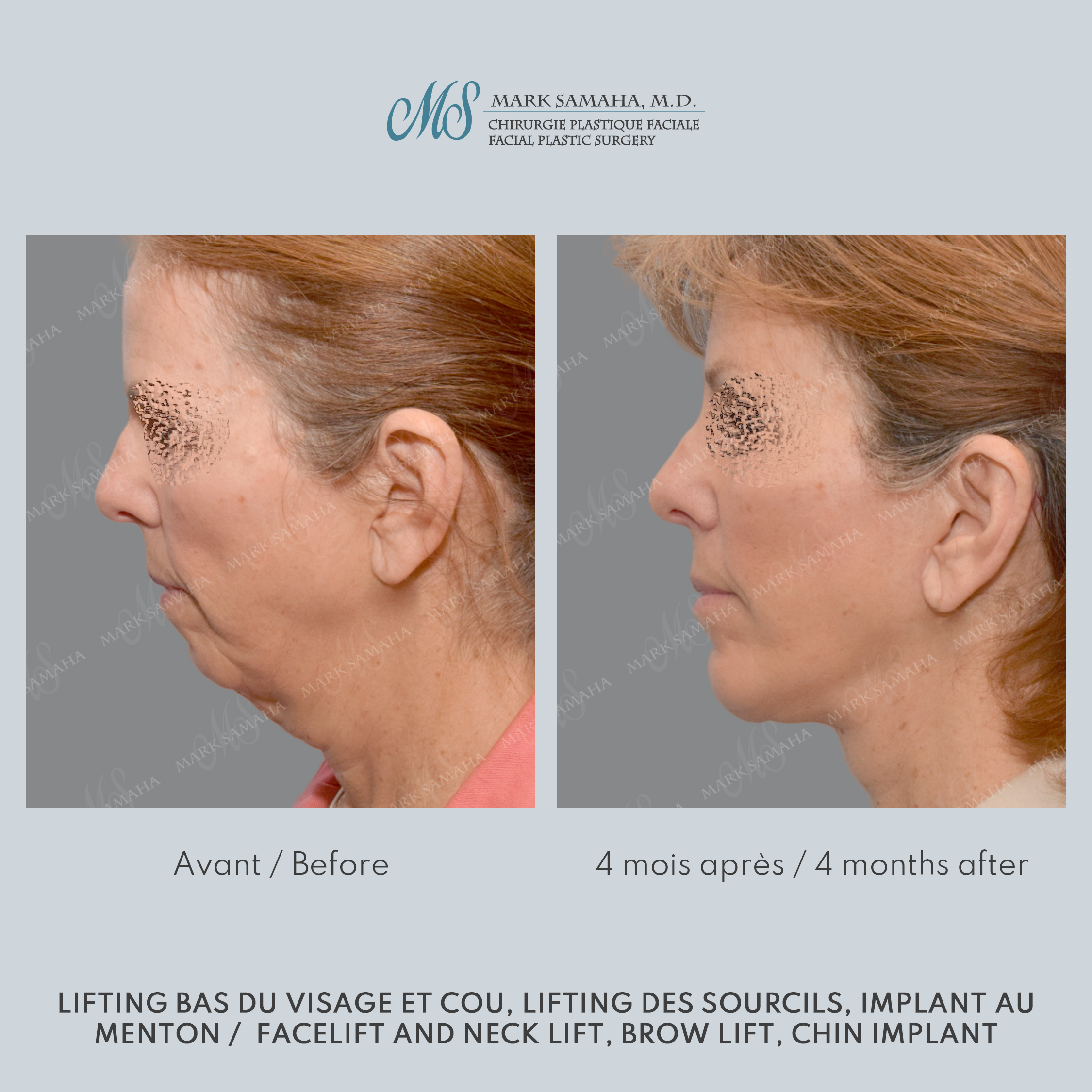 Before & After Lifting du visage / Cou - Facelift / Necklift Case 241 View #5 Detail View in Montreal, QC