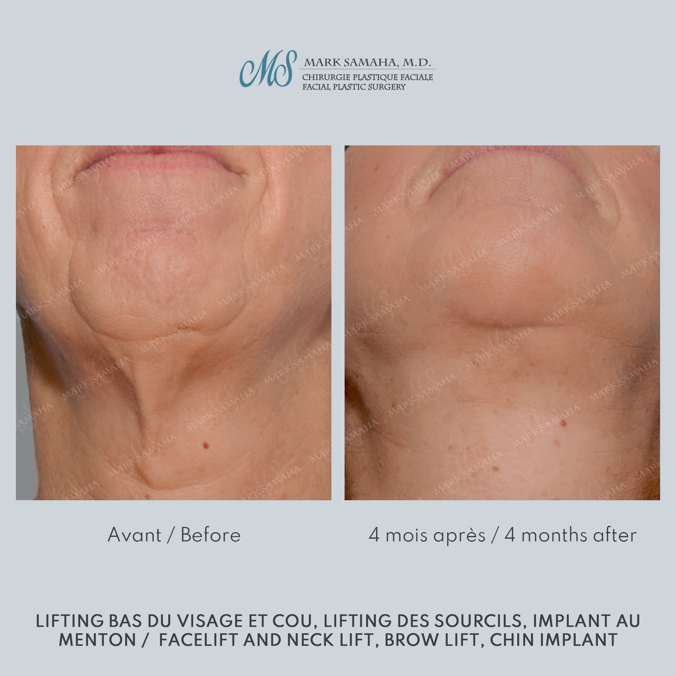 Before & After Lifting du visage / Cou - Facelift / Necklift Case 241 View #6 Detail View in Montreal, QC