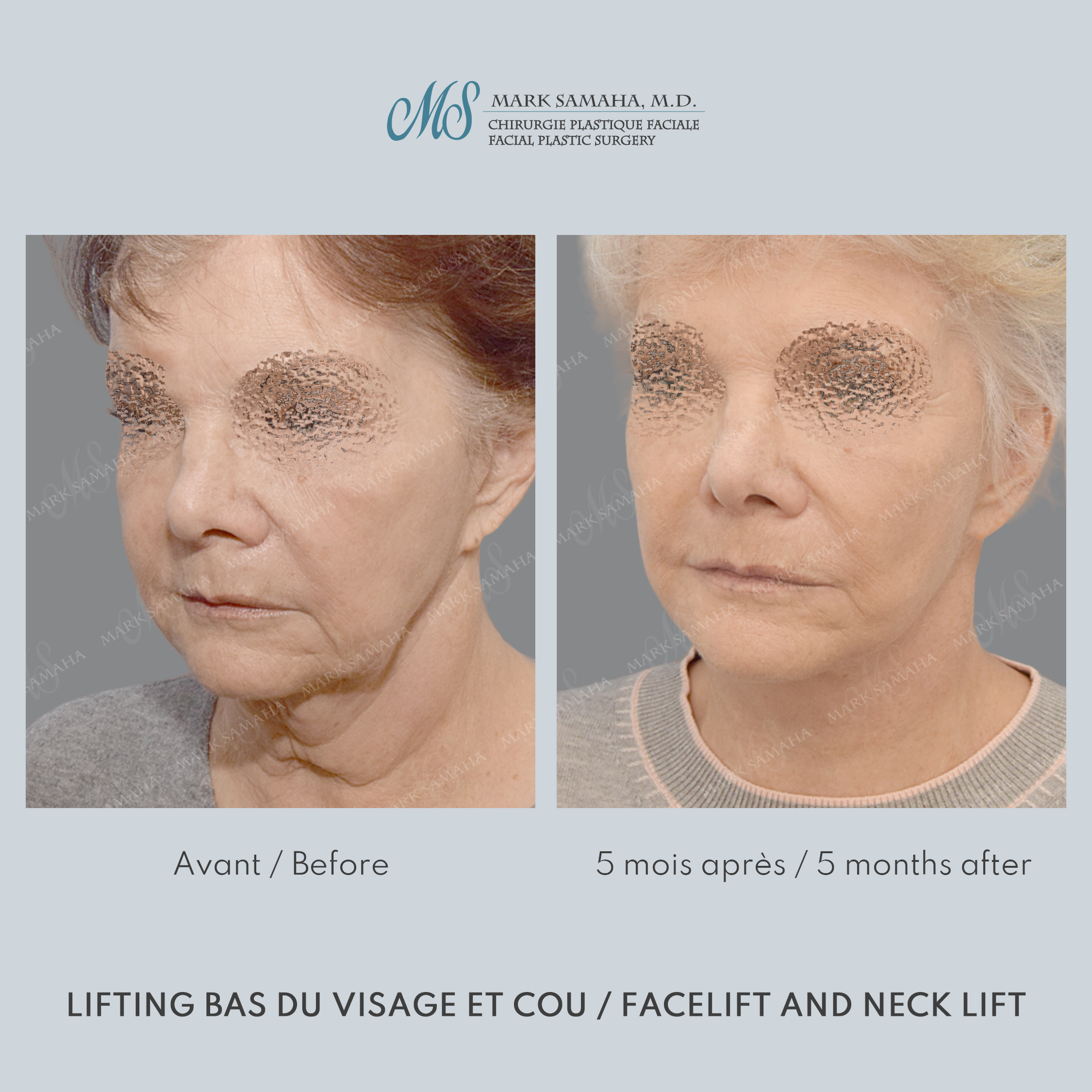 Before & After Lifting du visage / Cou - Facelift / Necklift Case 242 View #1 View in Montreal, QC
