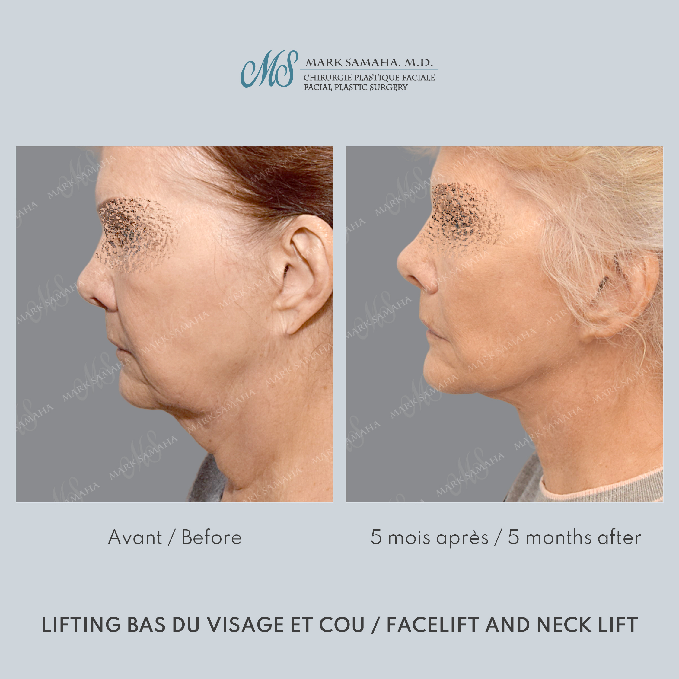 Before & After Lifting du visage / Cou - Facelift / Necklift Case 242 View #2 Detail View in Montreal, QC