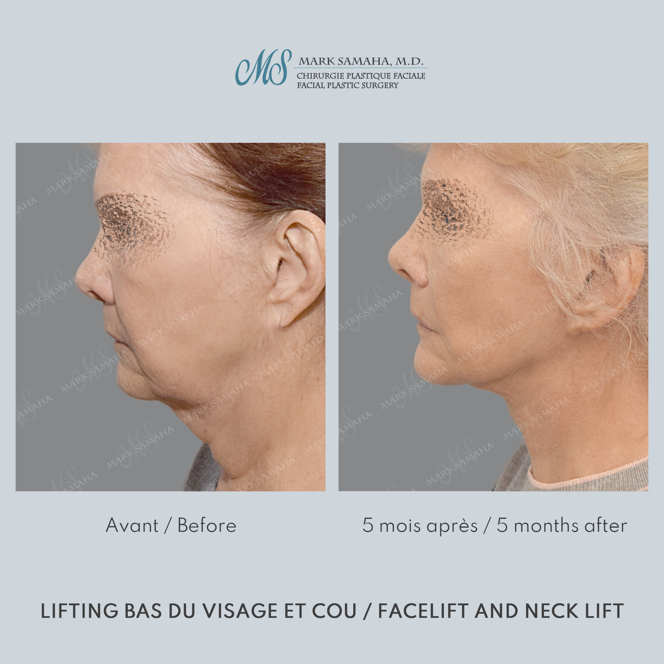 Before & After Lifting du visage / Cou - Facelift / Necklift Case 242 View #2 View in Montreal, QC