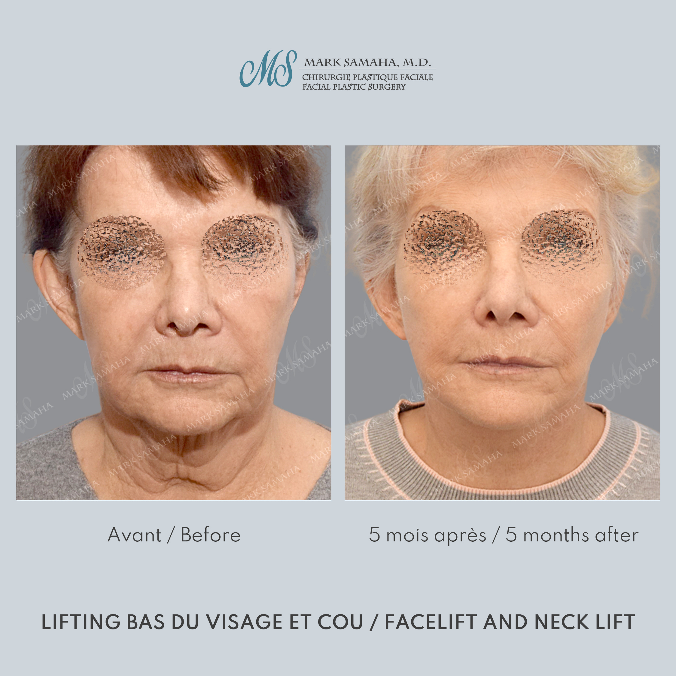 Before & After Lifting du visage / Cou - Facelift / Necklift Case 242 View #3 Detail View in Montreal, QC