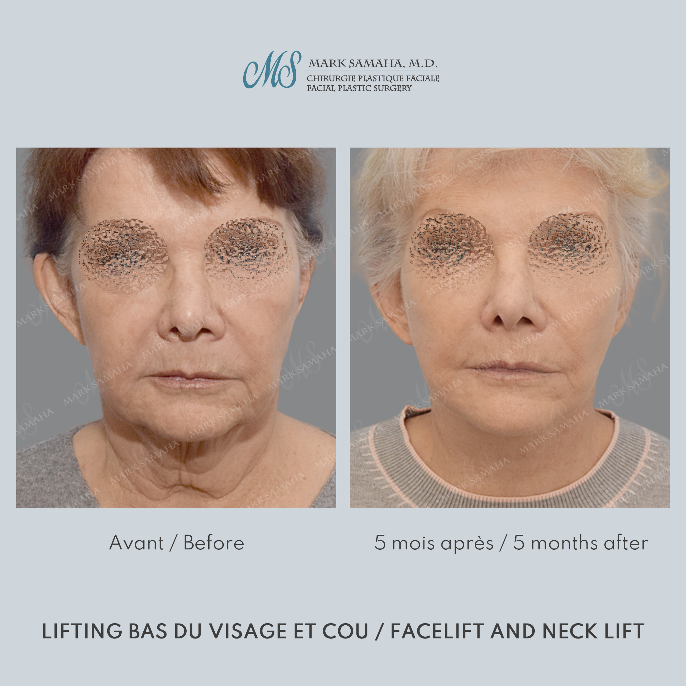 Before & After Lifting du visage / Cou - Facelift / Necklift Case 242 View #3 View in Montreal, QC