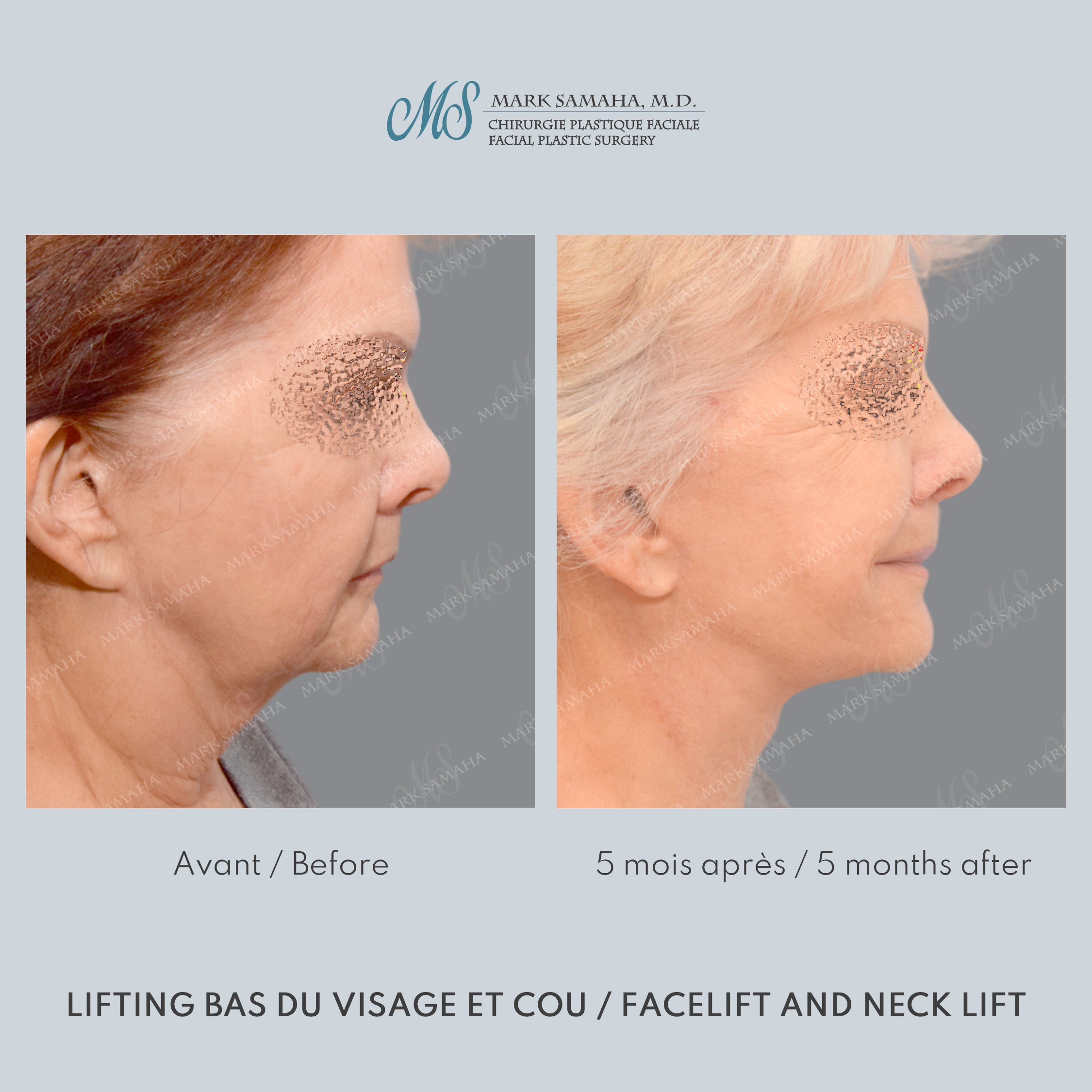 Before & After Lifting du visage / Cou - Facelift / Necklift Case 242 View #4 Detail View in Montreal, QC